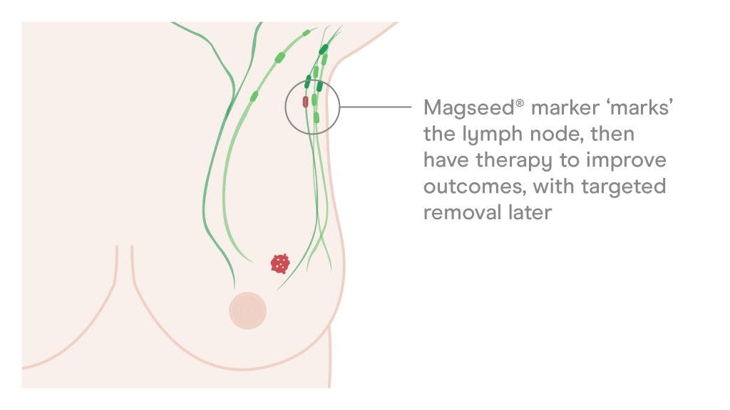 Illustration of Magseed marker 'marking' cancerous lymph node in the underarm 