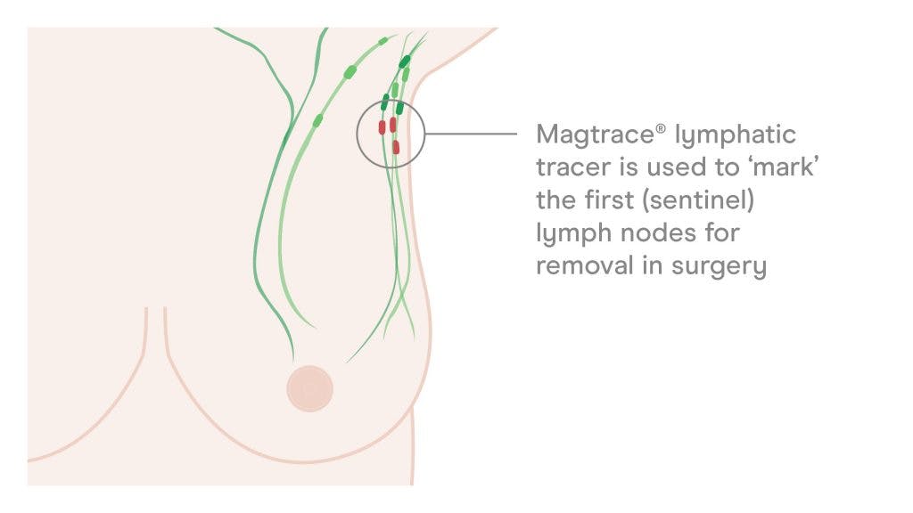 magtrace lymphatic tracer in nodes illustration