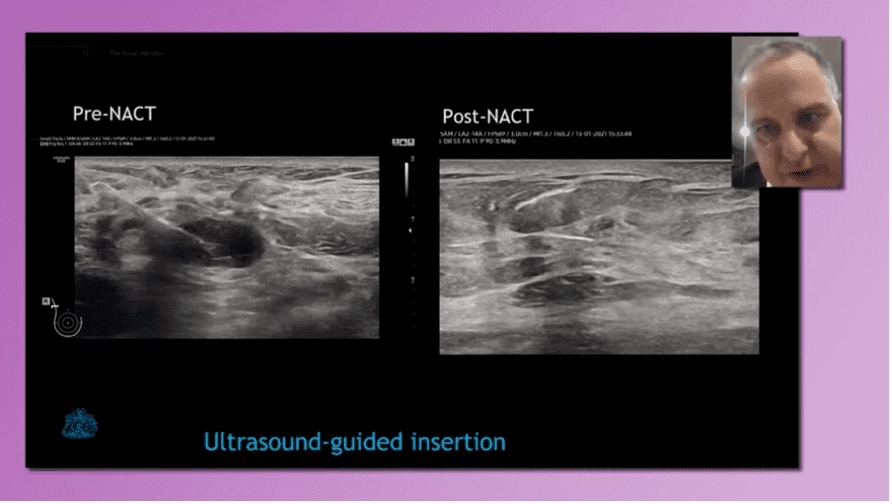 Magseed Ultrasound Guided Insertion