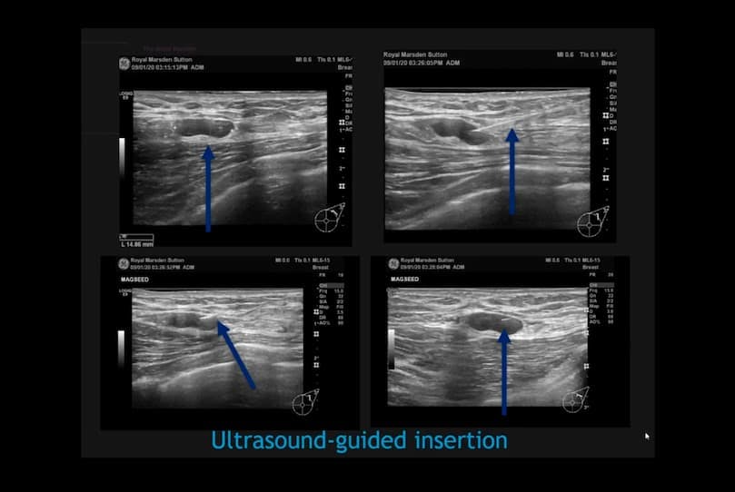 Symposium Mammographicum presentation slide