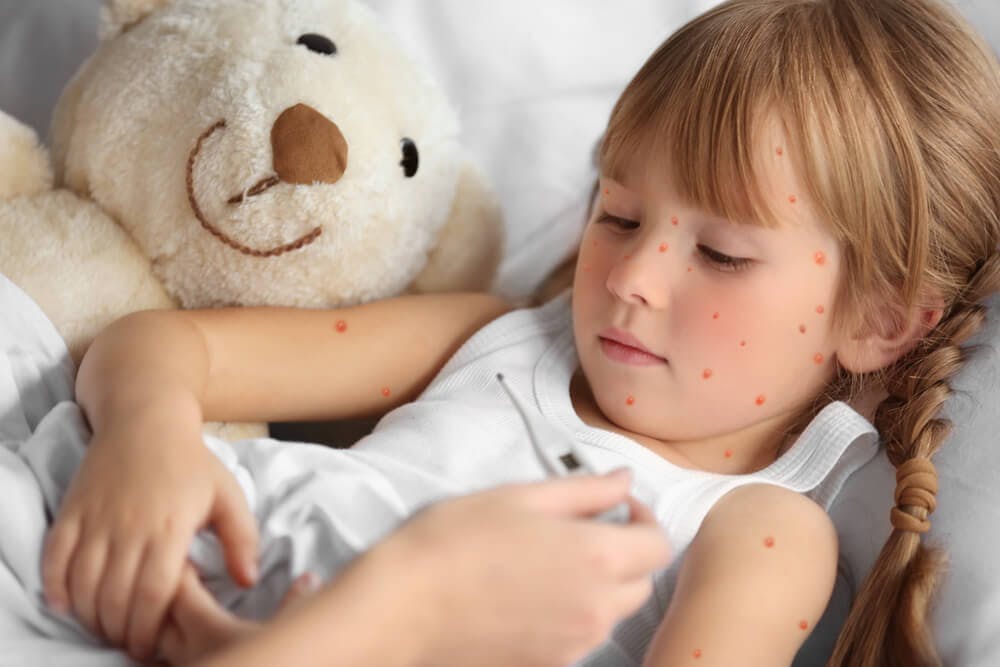 Varicella nei bambini: come si contagia? Sintomi e cure