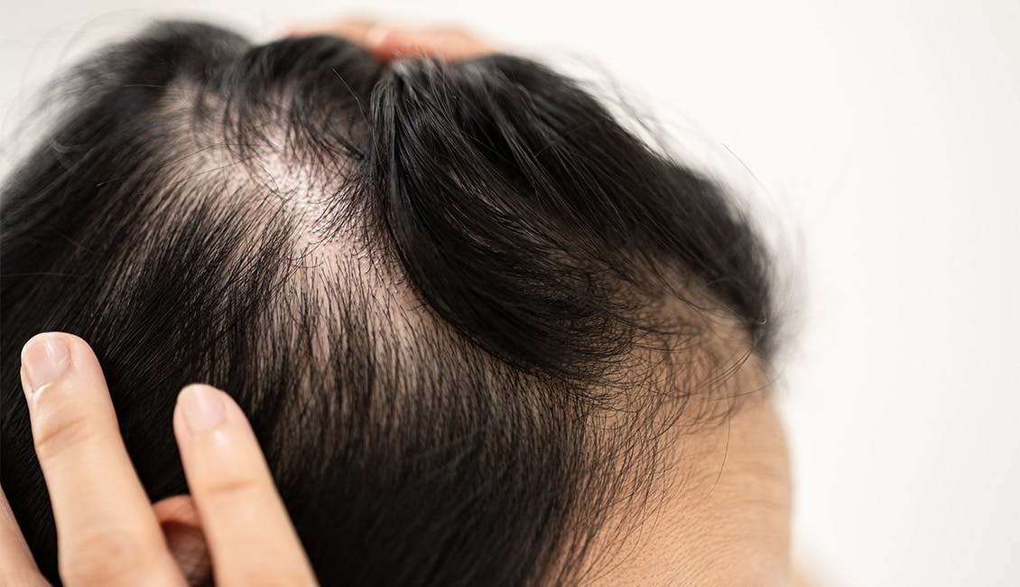 A close up of a woman's part that appears to be thinning.