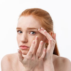 Consejos para cuidar tu piel del acné en 2023