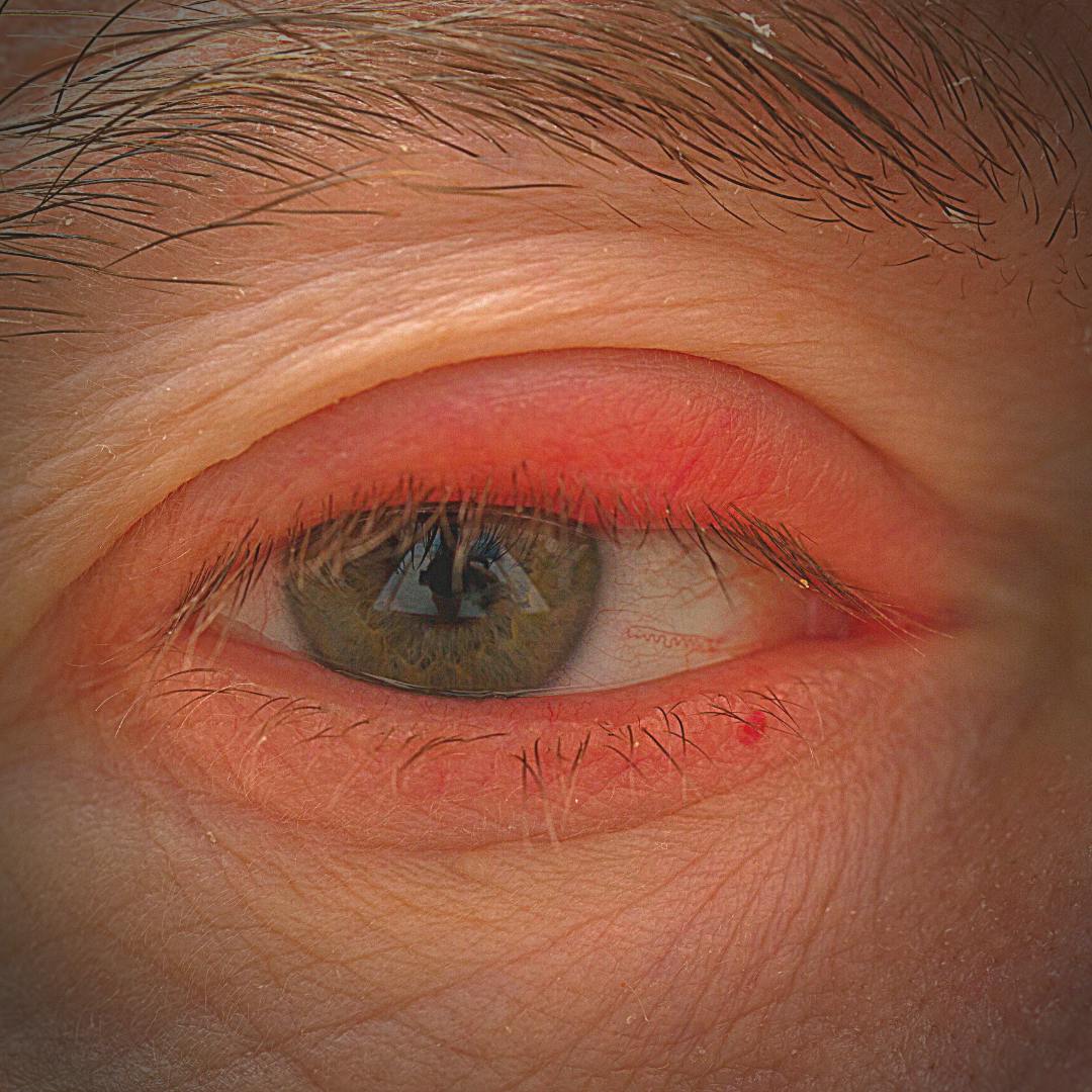 preseptal cellulitis of left eye icd 10