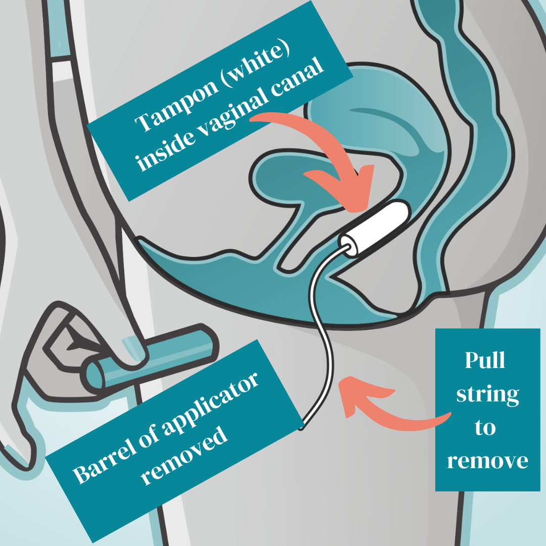 Sucrer Augmenter Souris Ou Rat Diagram Of Where A Tampon Goes Maximiser ...