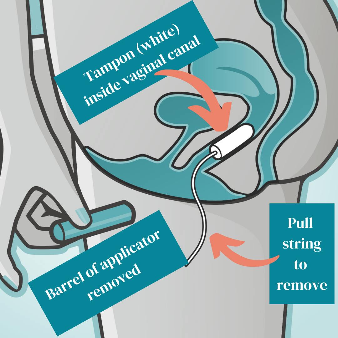 Diagram For Tampon Insertion