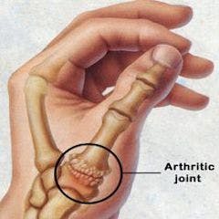 Thumb Arthritis Arthritic Joint