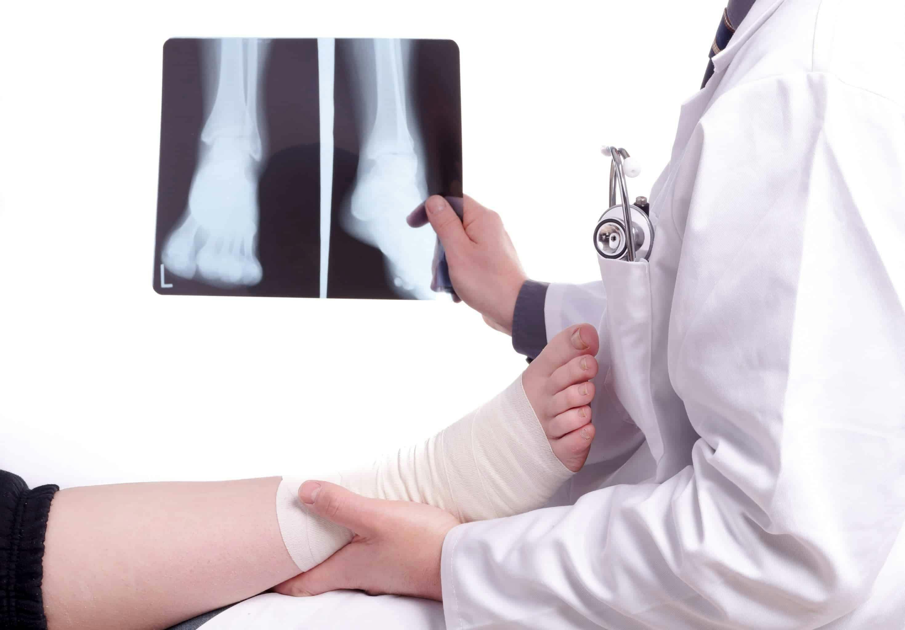 Ankle Replacement Alternatives North Florida Bone & Joint Specialists