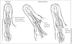 Thumb Ulnar Collateral Ligament Injury