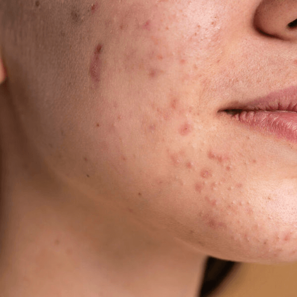 Acné