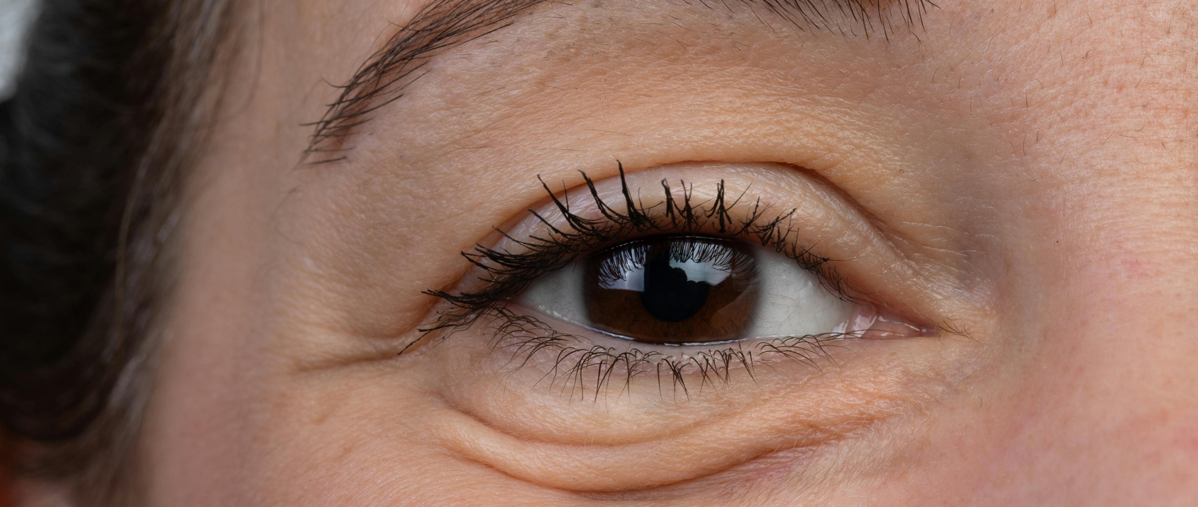 A picture of woman with puffy brown eyes