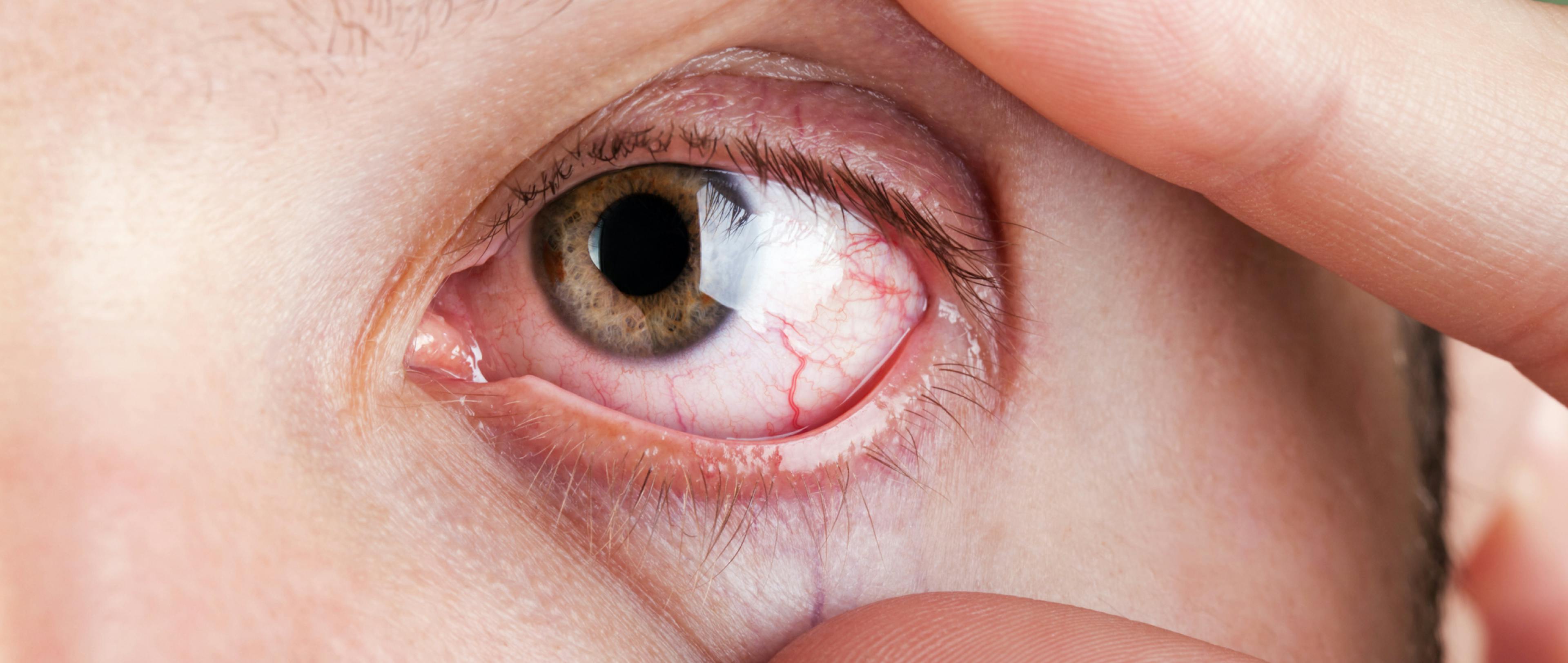 dry eyes with blood capillaries 