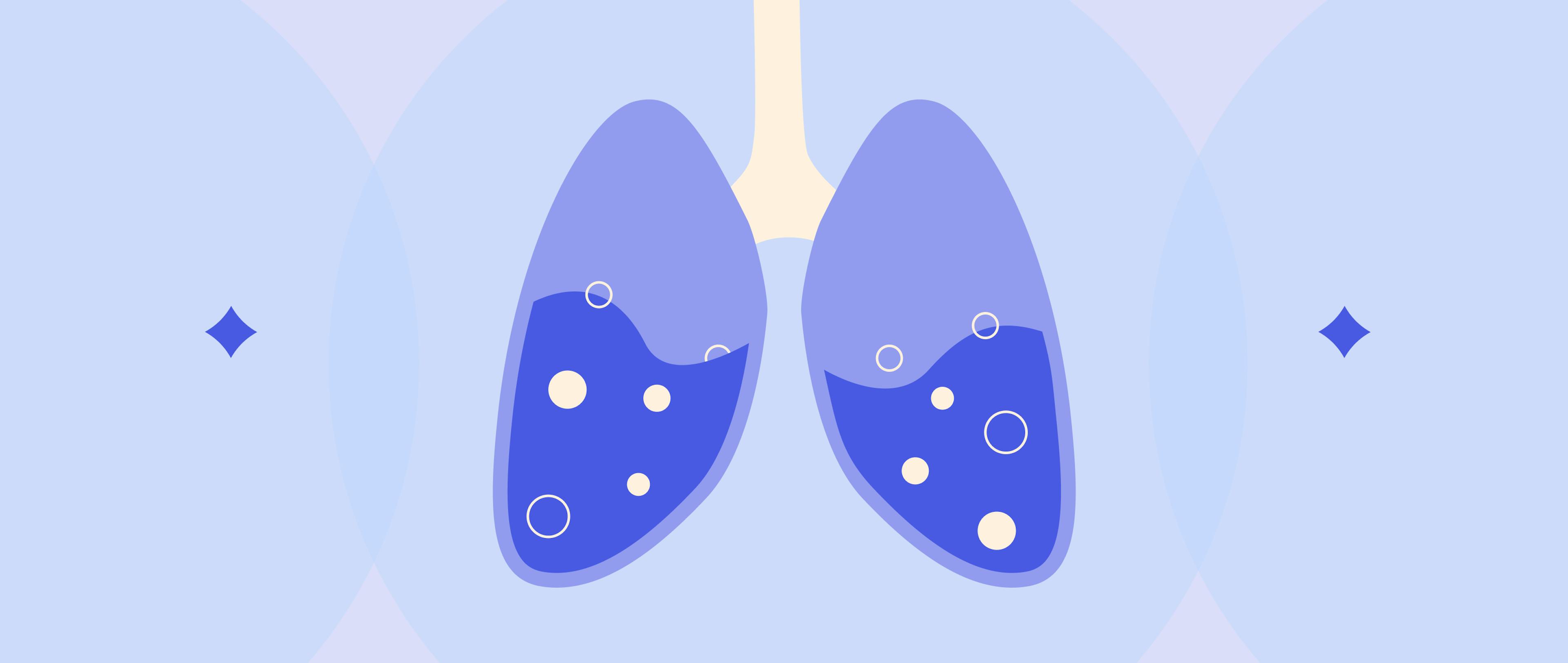 An image of lungs which are filled with fluid and have bubbles in them.