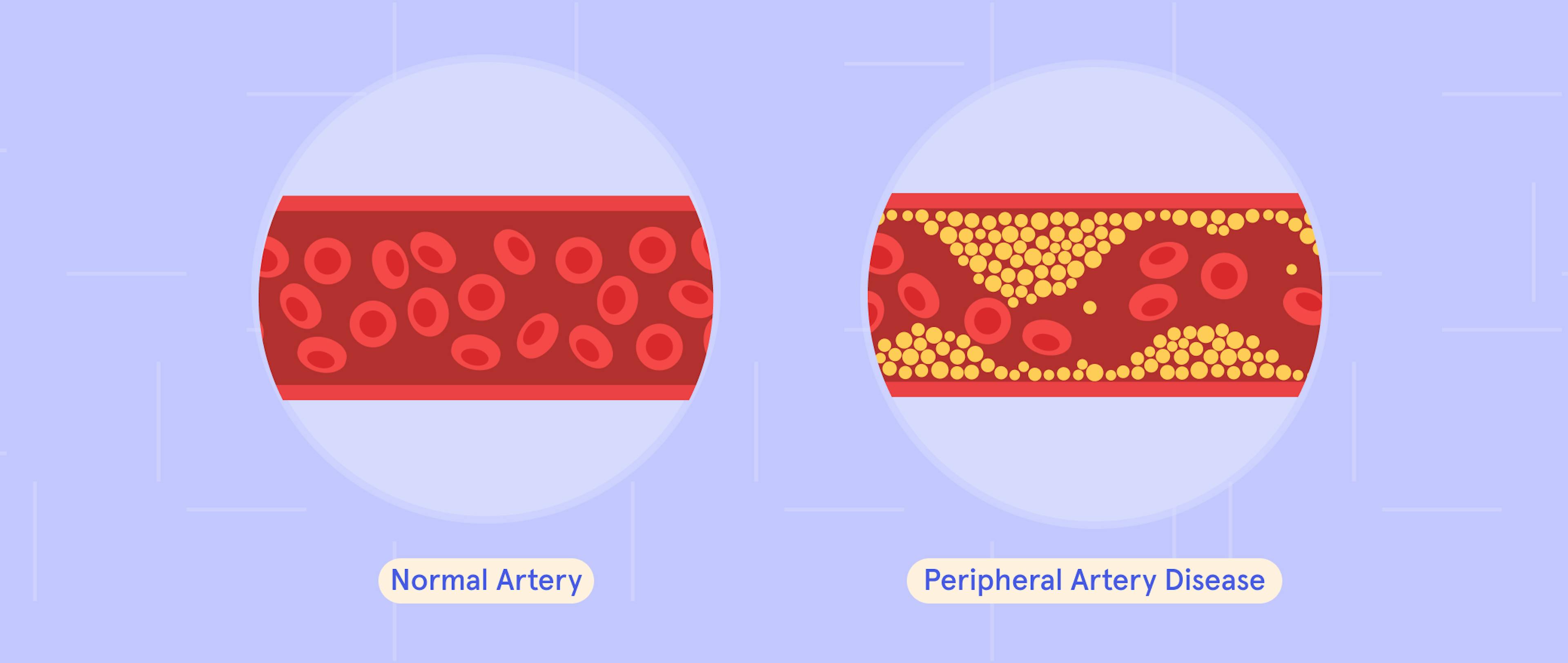 A pictorial representation of a normal artery and a peripheral artery