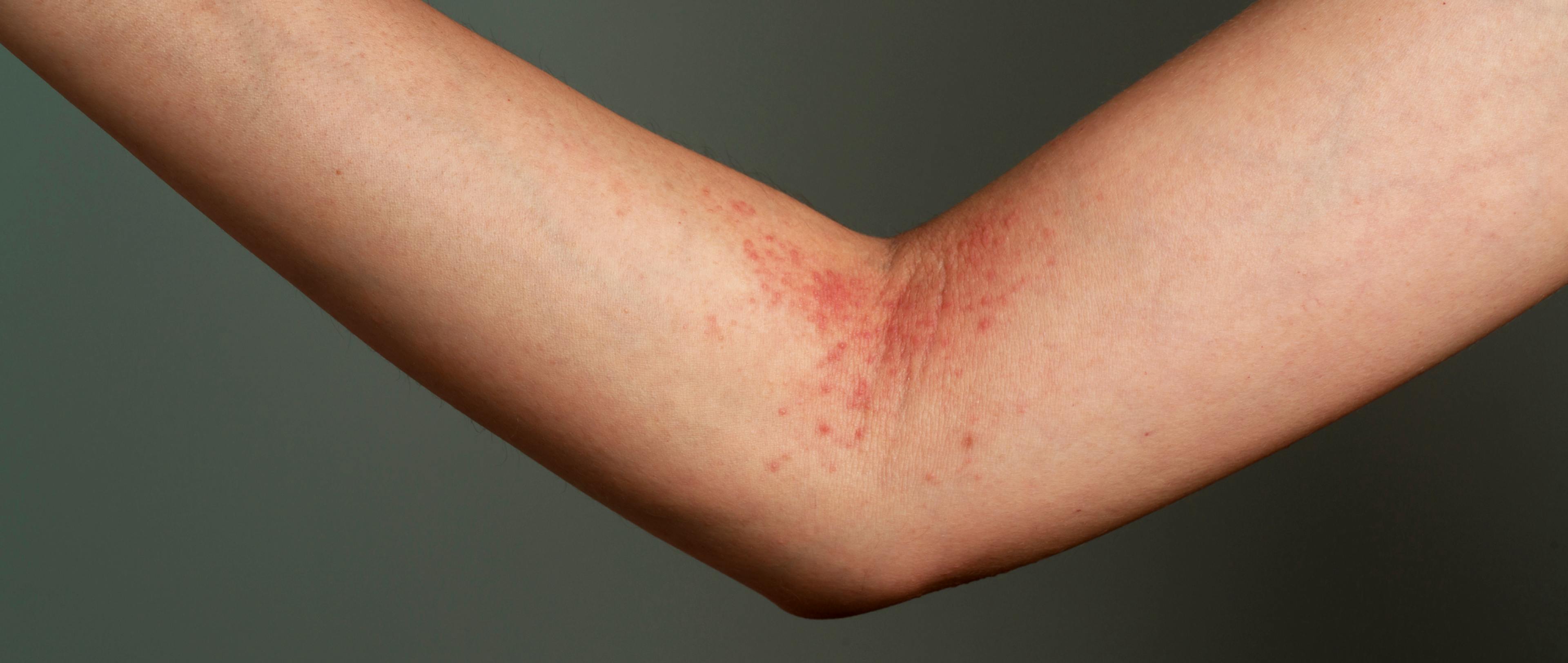 Contact Dermatitis: Causes, Signs, Types & Treatment | Fluent Health