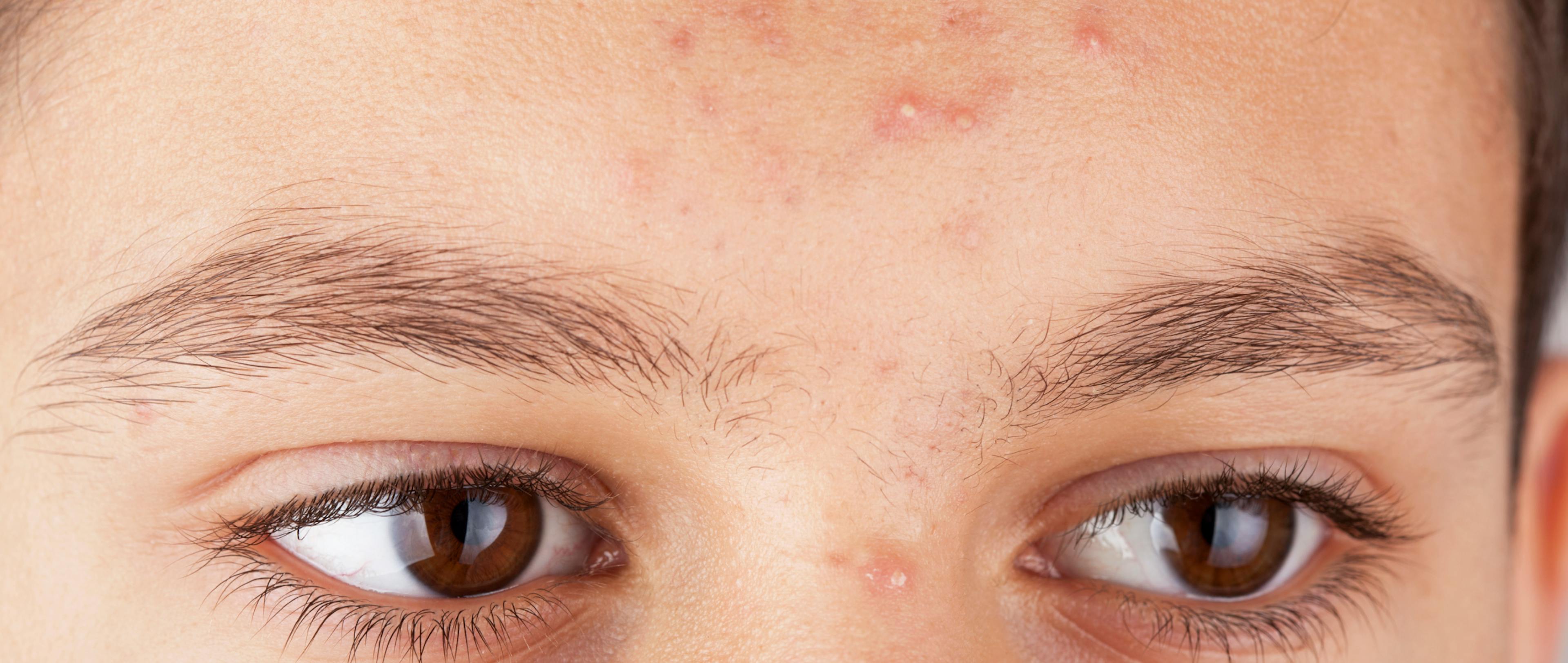 An illustration depicting an individual experiencing acne on their face.