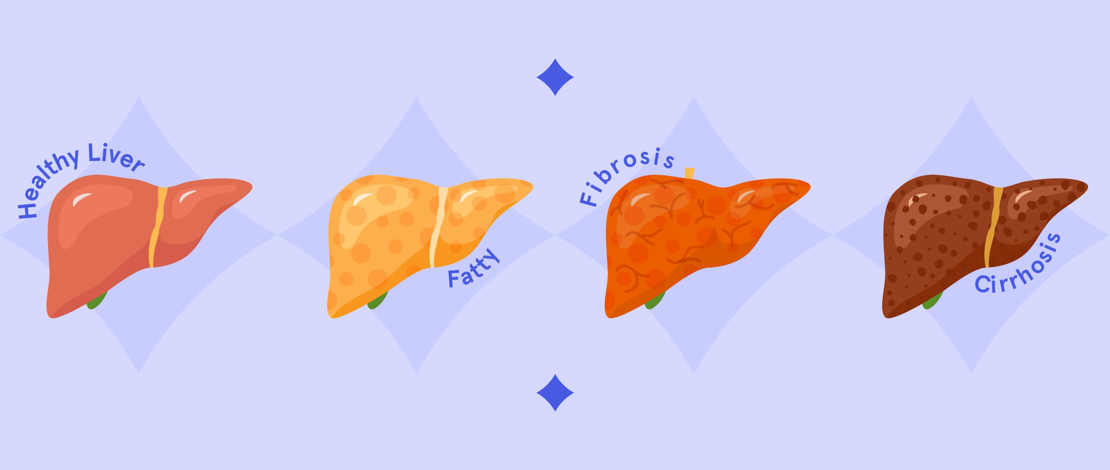 A visual representation of healthy and unhealthy liver.