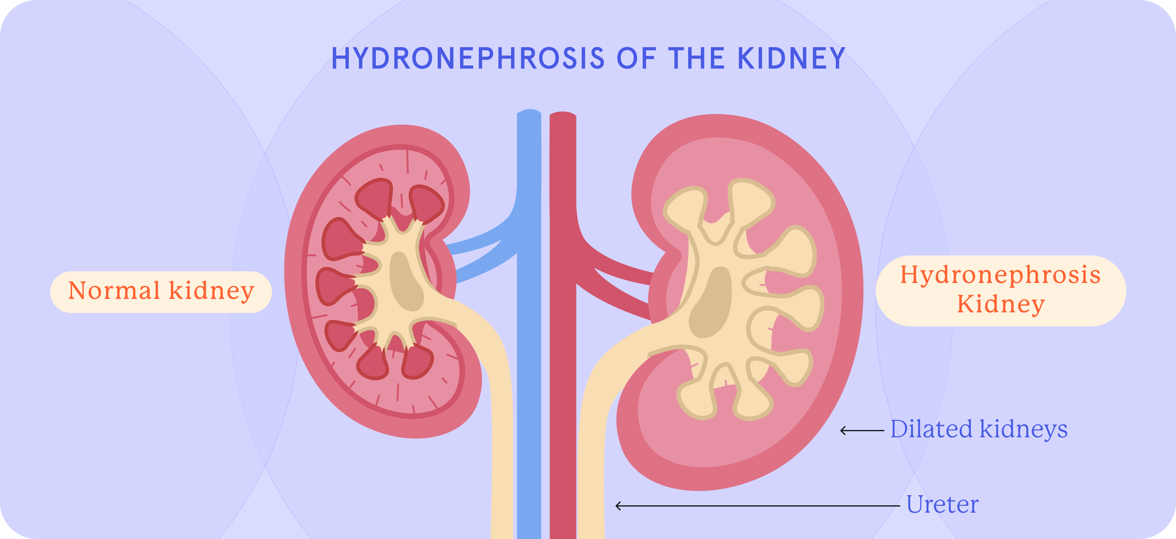 A graphic representation of hydronephrosis of the kidney