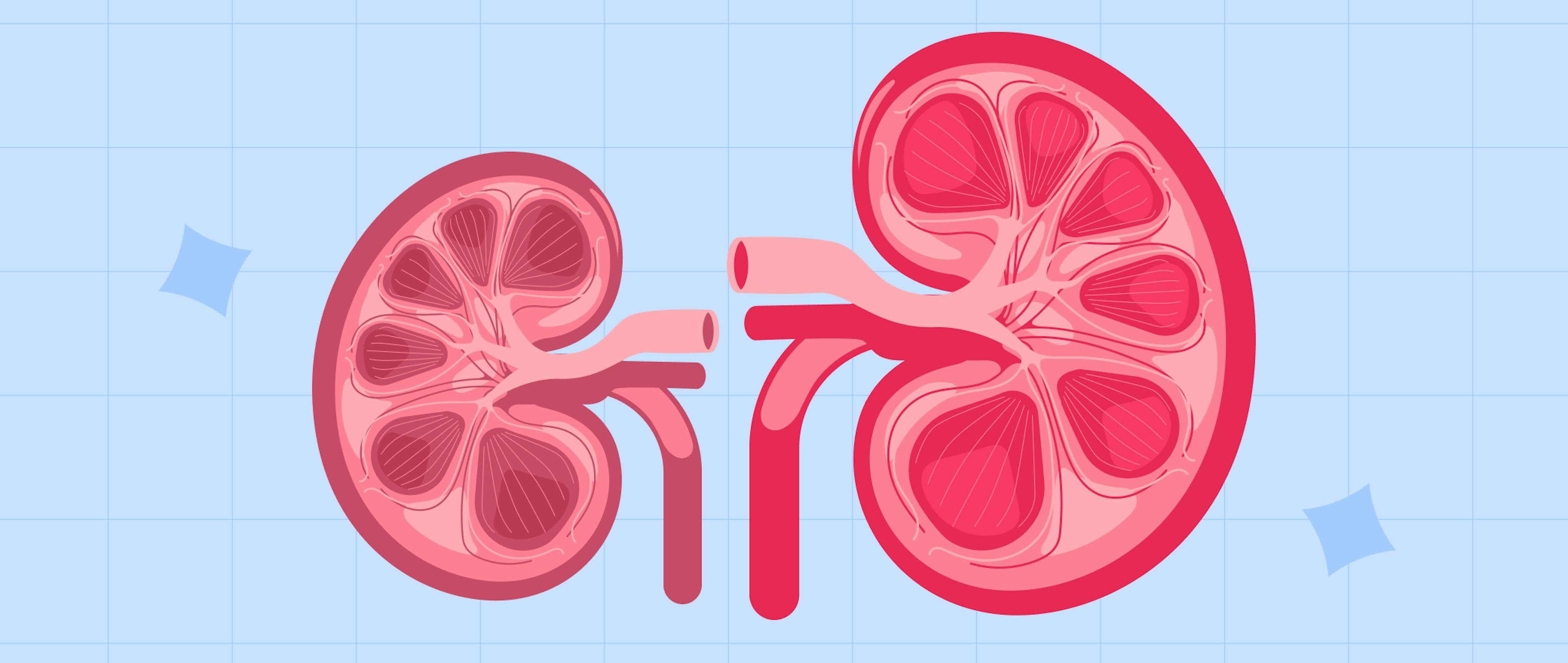 A graphic representation of a swollen kidney against a normal one