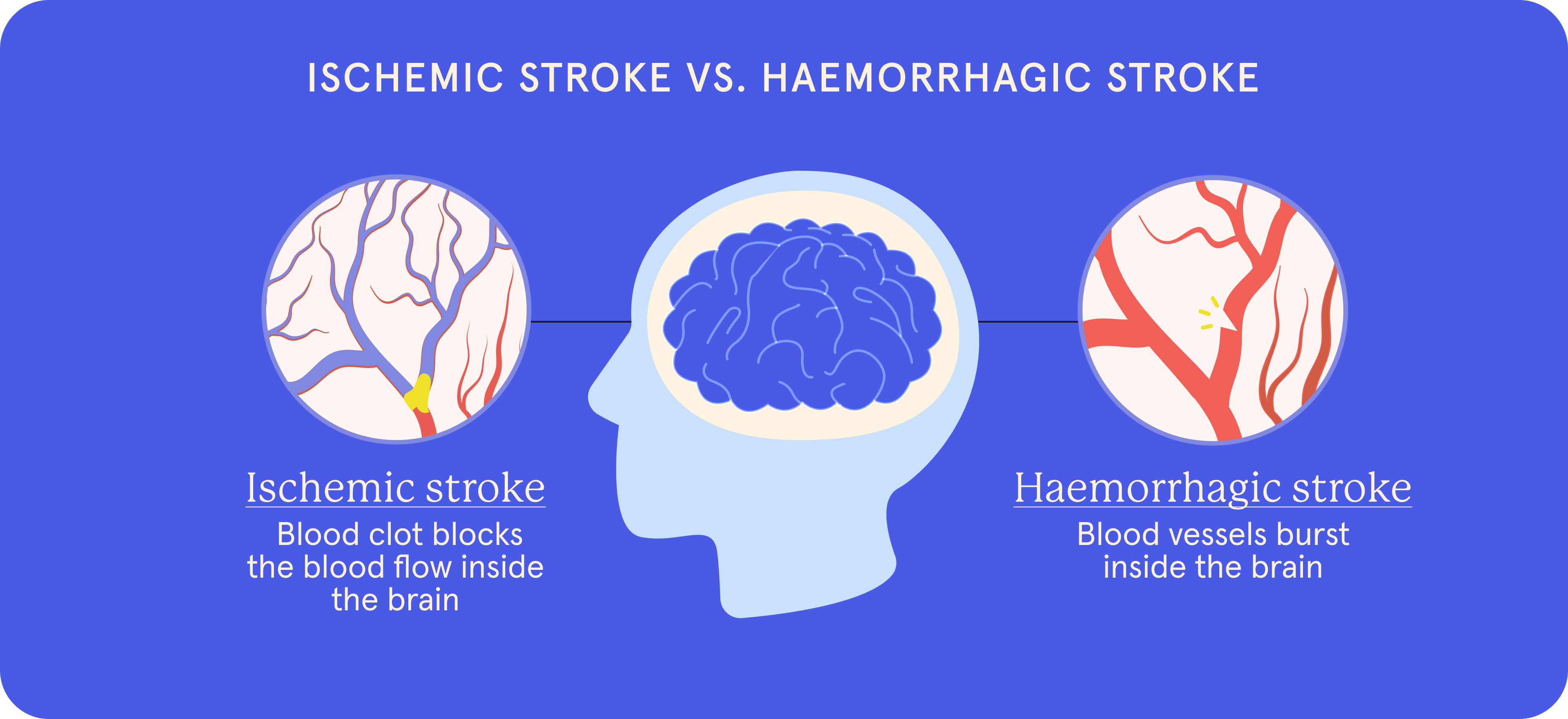 A visual representation of Ischemic stroke vs. Haemorrhagic stroke