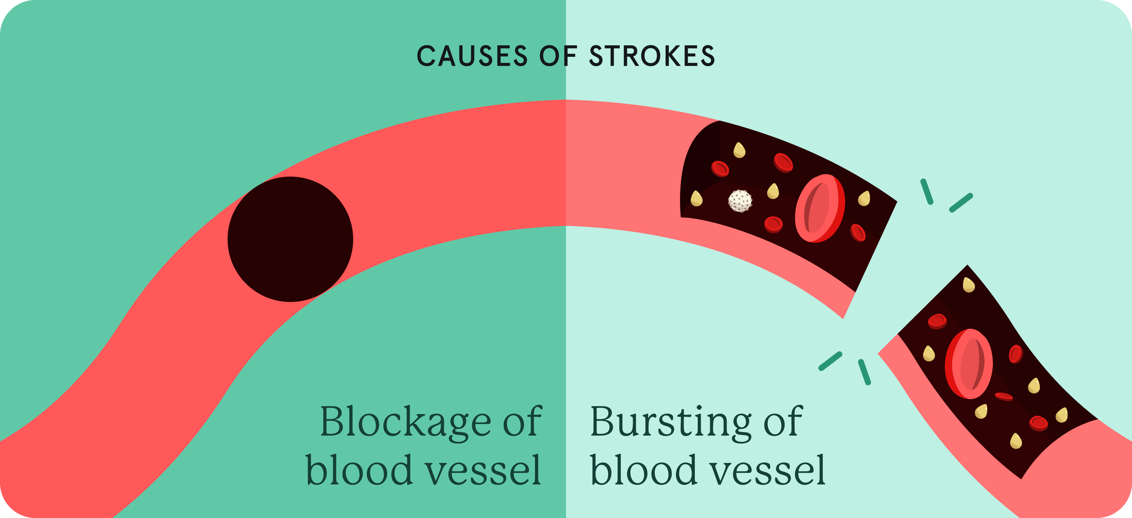 A pictorial representation of the causes of stroke