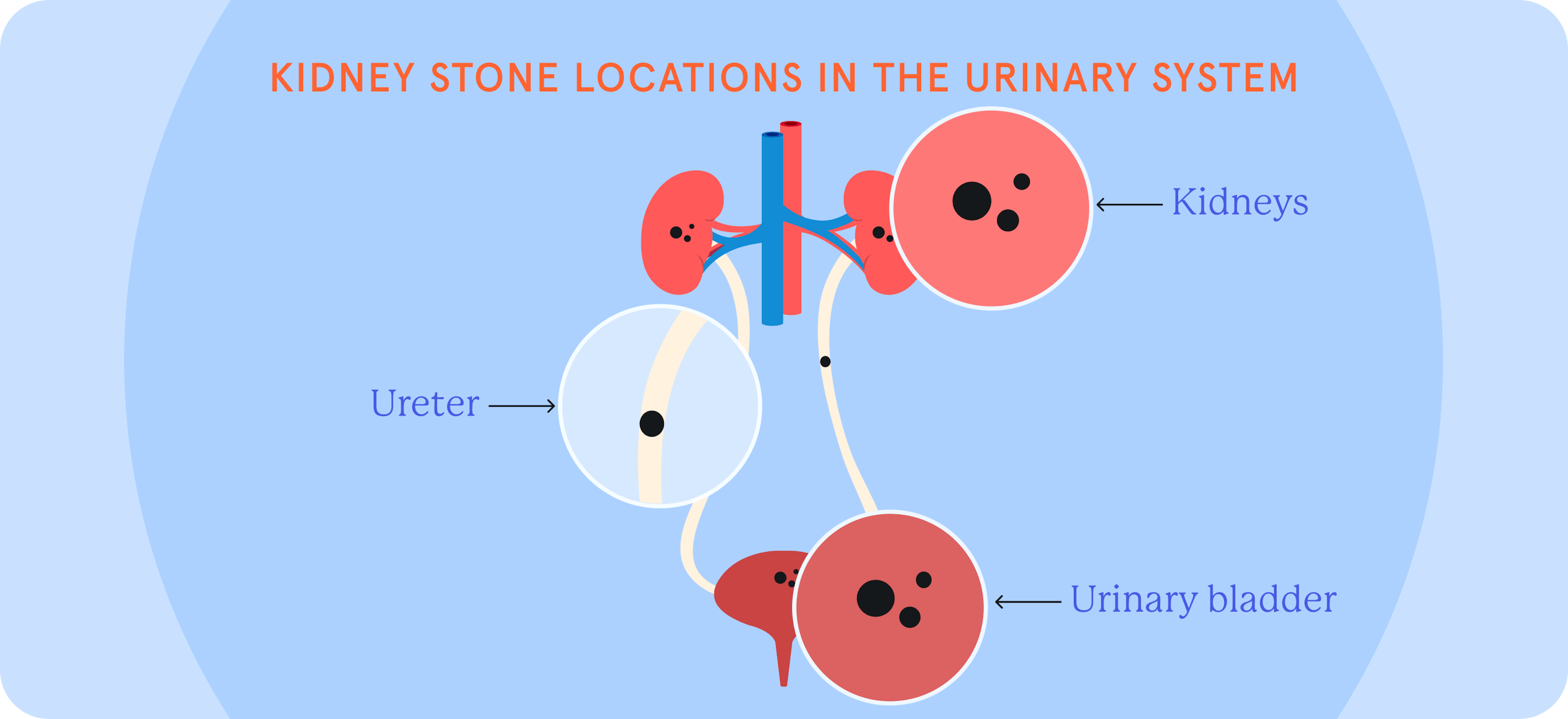 An infographic showing kidney stone locations in the urinary system