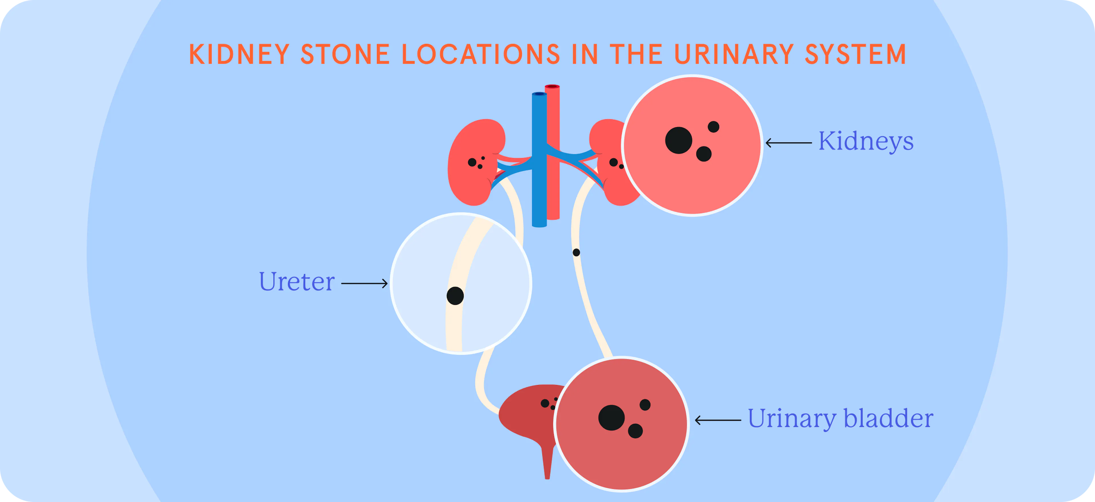 Stone Location Stones To Solutions: A Kidney Stones Guide | Fluent Health