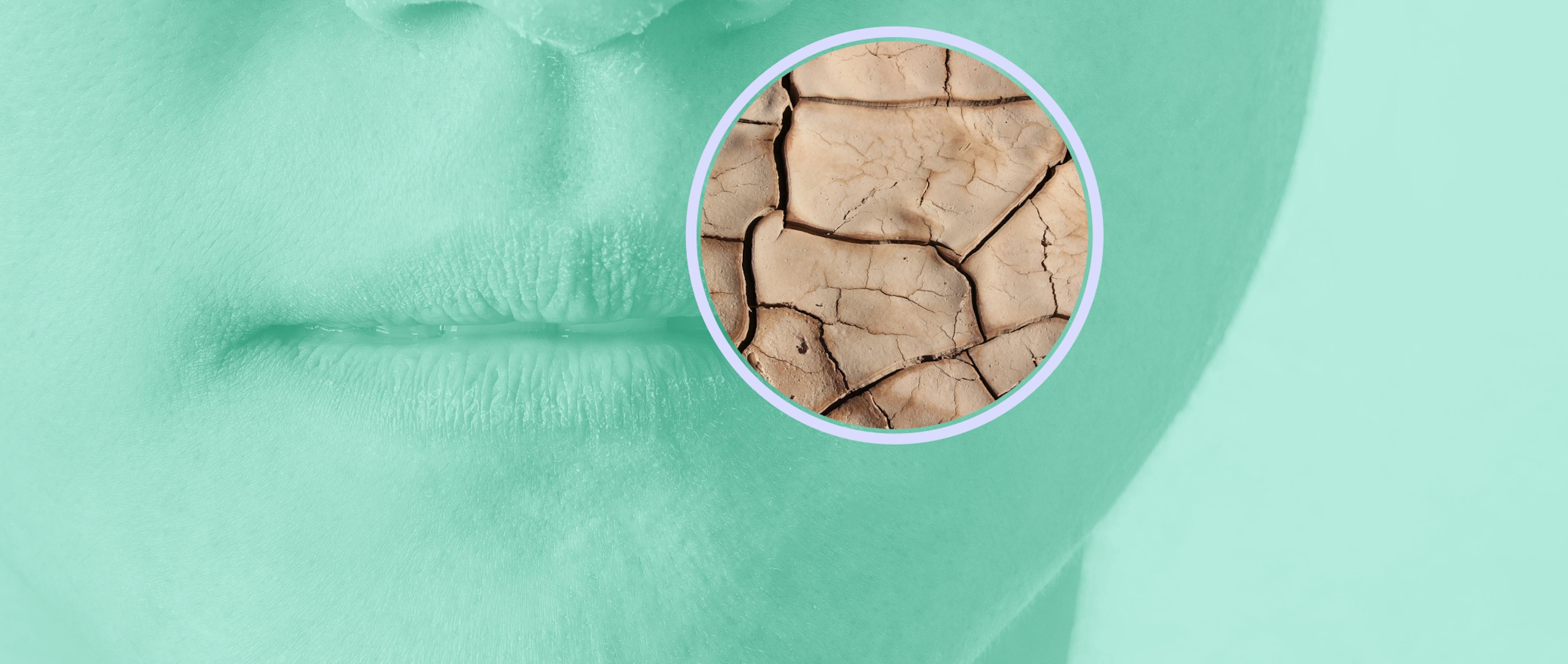 Image of a person's face with a zoomed in section of the area over the lips that has extremely dry skin.