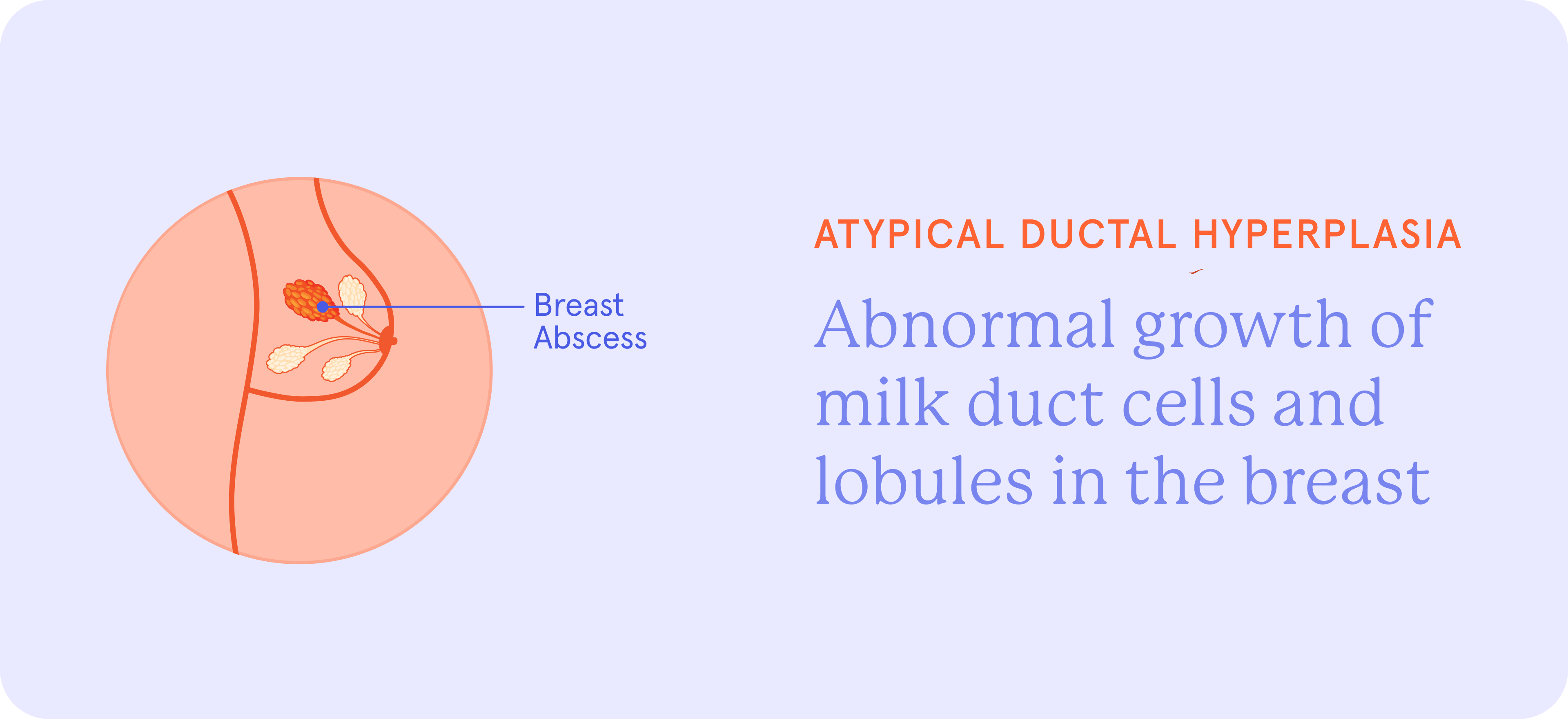 Infographic showing abnormal growth of milk duct cells and lobules in the breast.