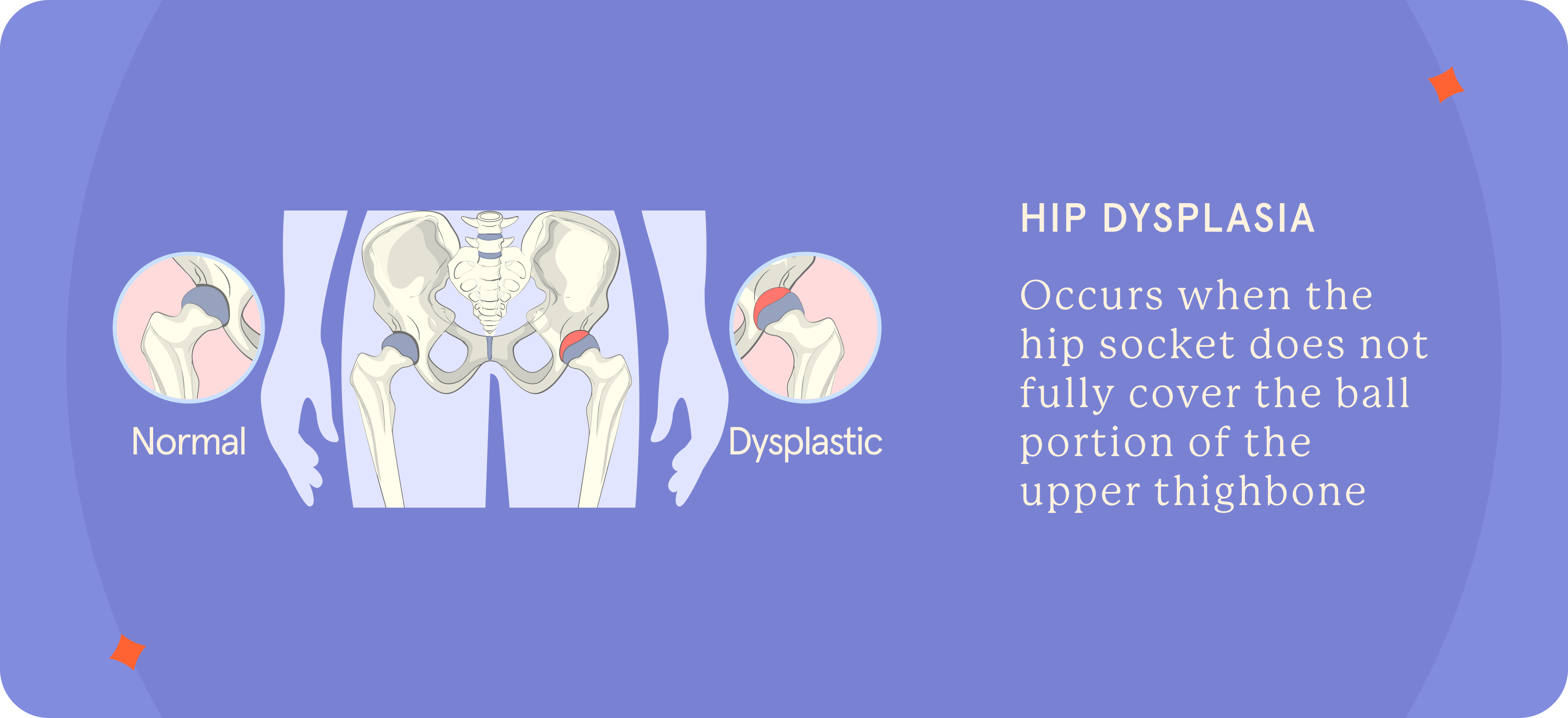 A pictorial presentation of Hip Dysplasia