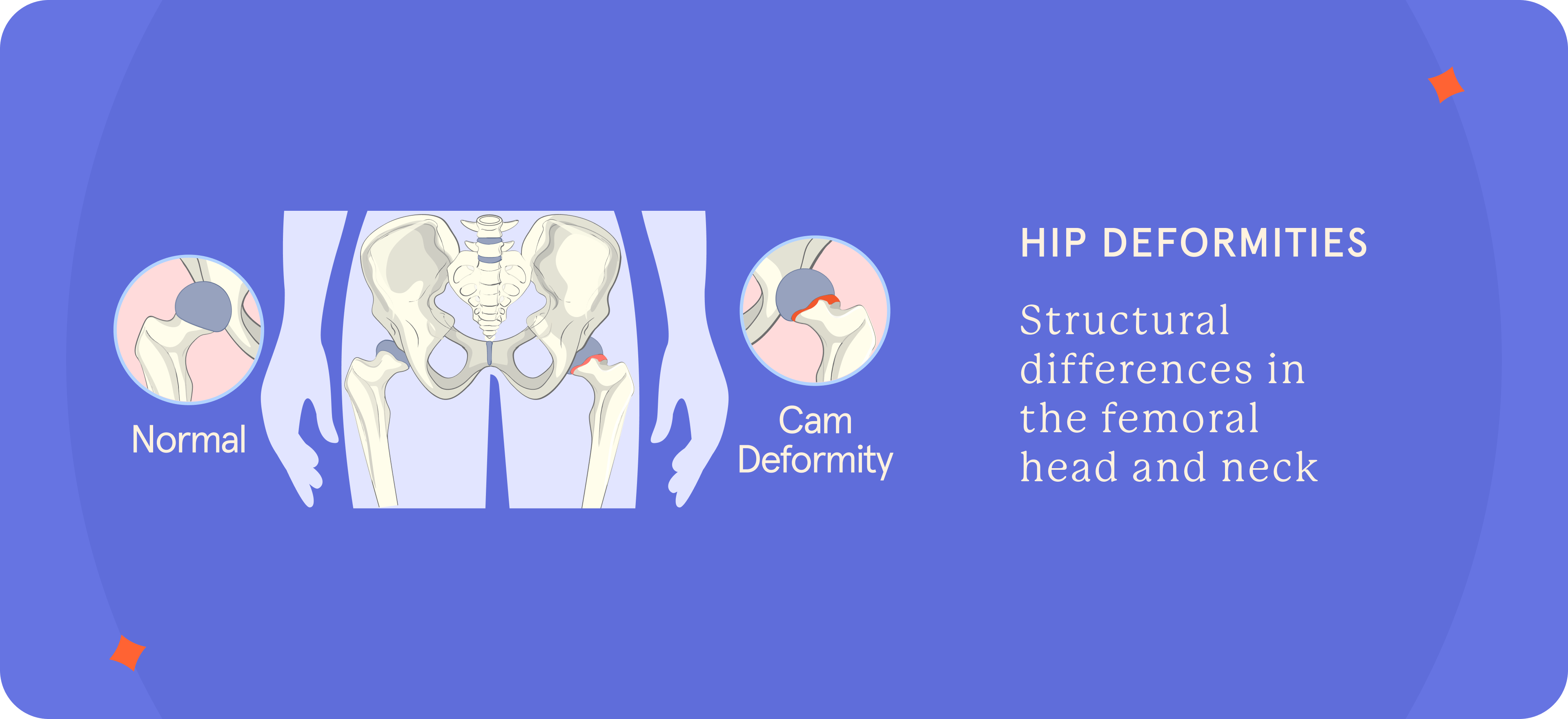 A pictorial presentation of Hip Deformities