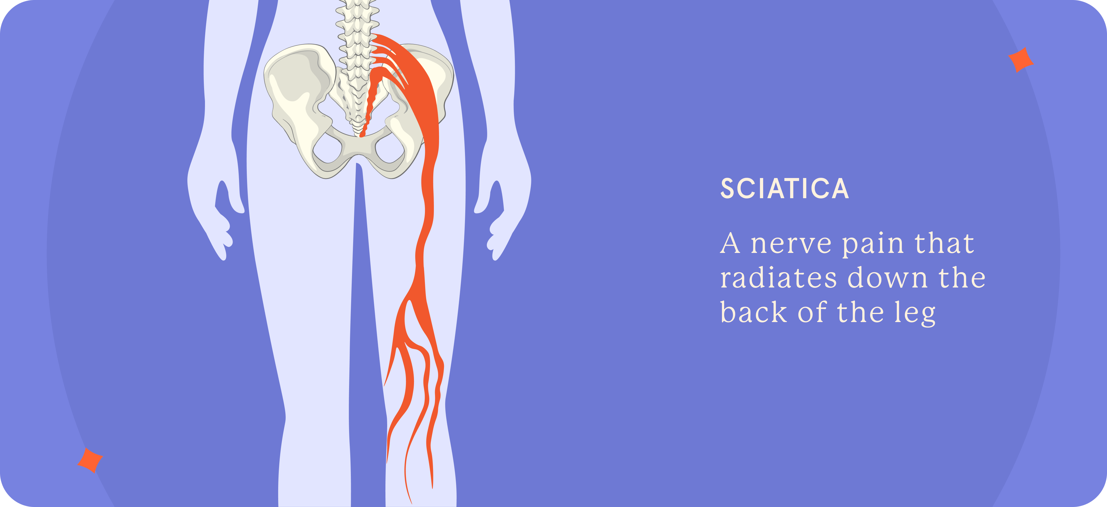 A representation of Sciatica