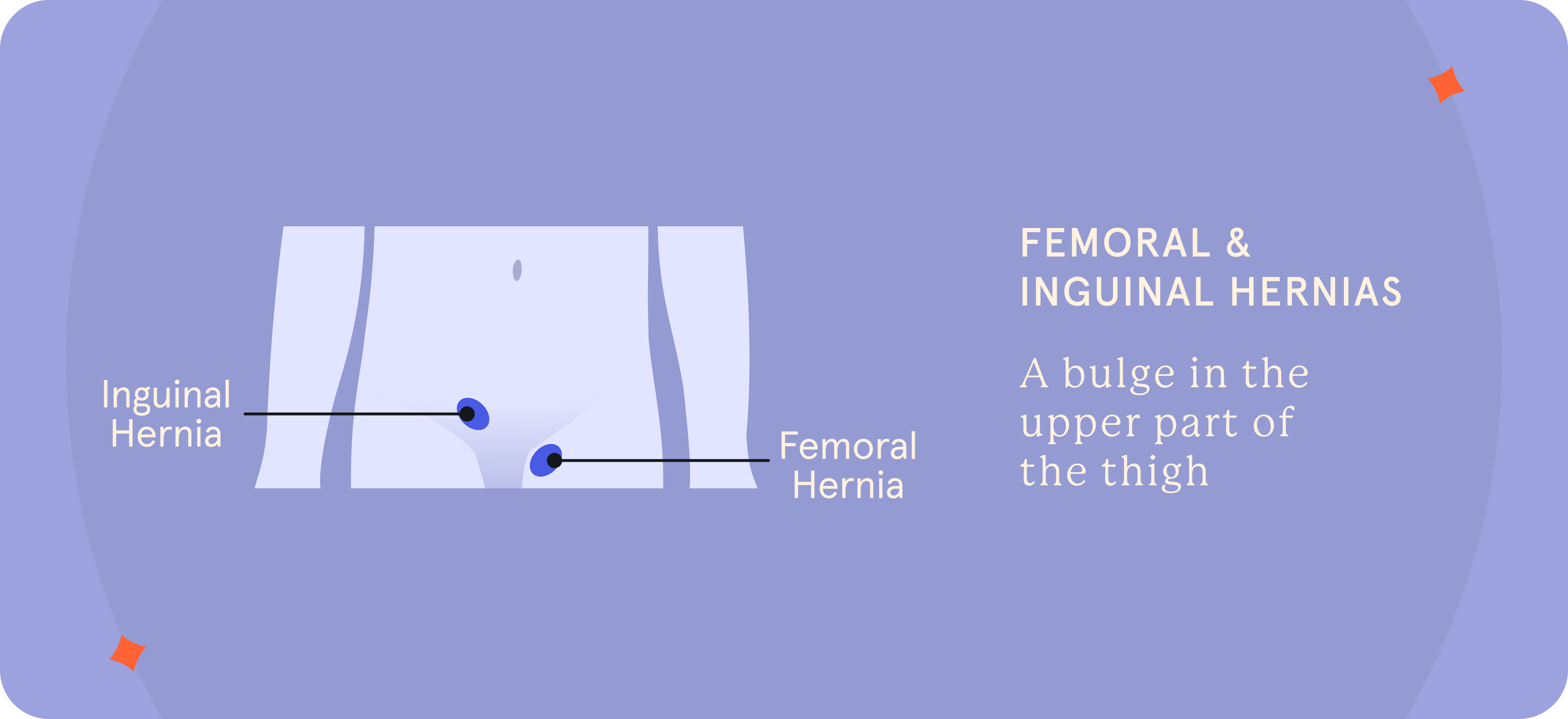 A pictorial presentation of Femoral and Inguinal Hernias