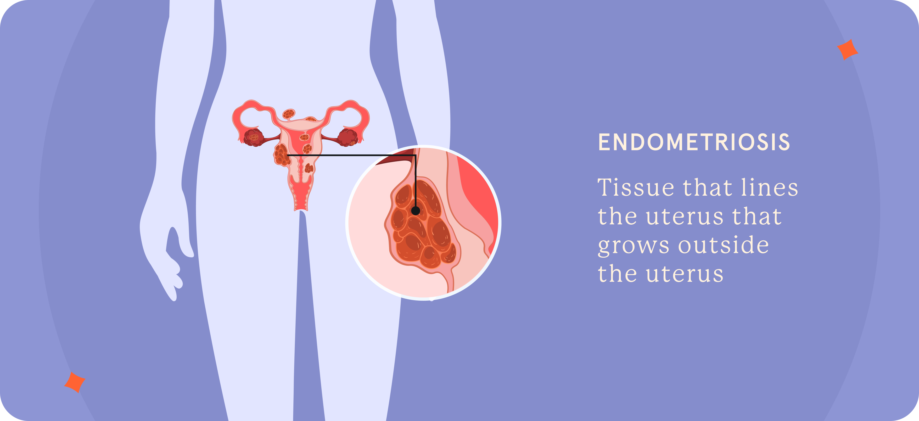 A pictorial presentation of Endometriosis