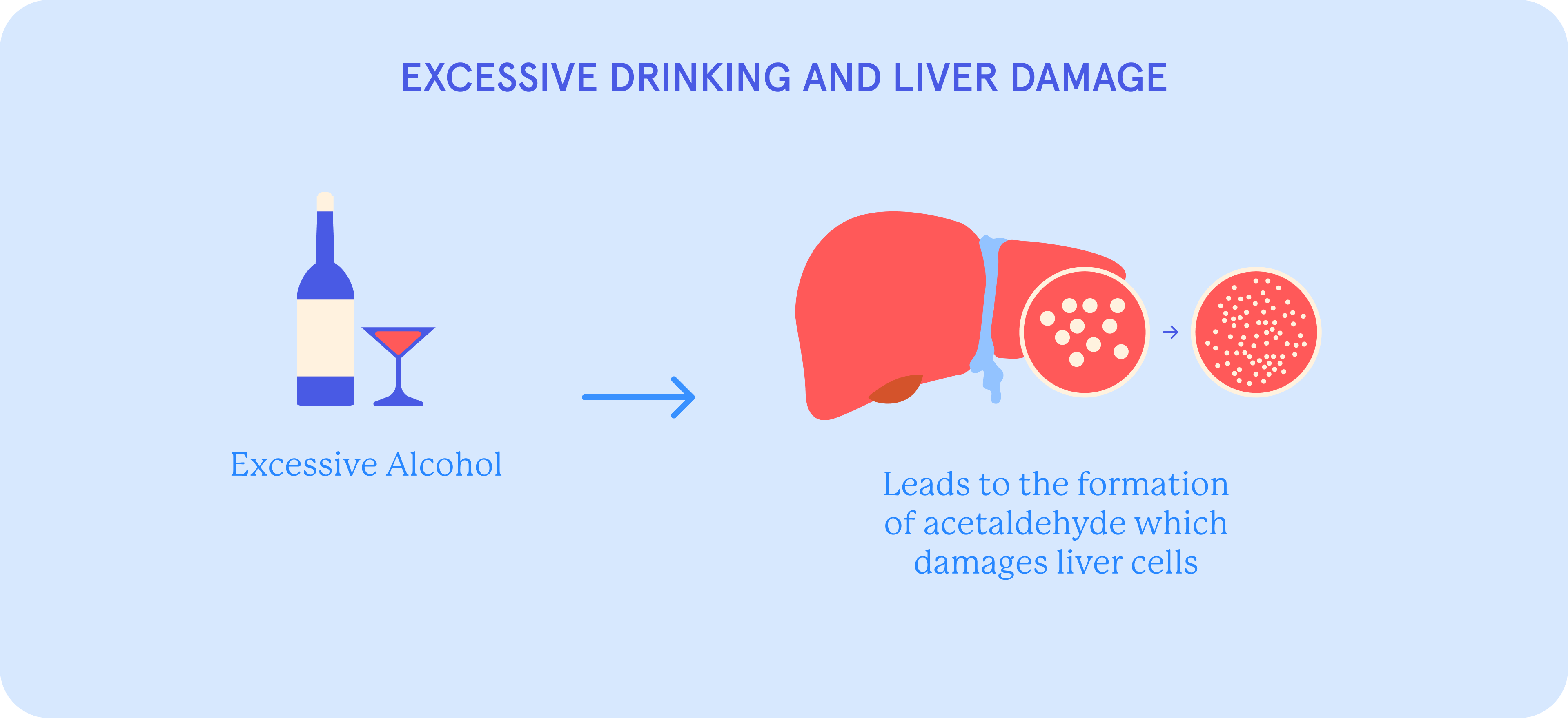 Infographic explaining how excessive drinking leads to liver damage.