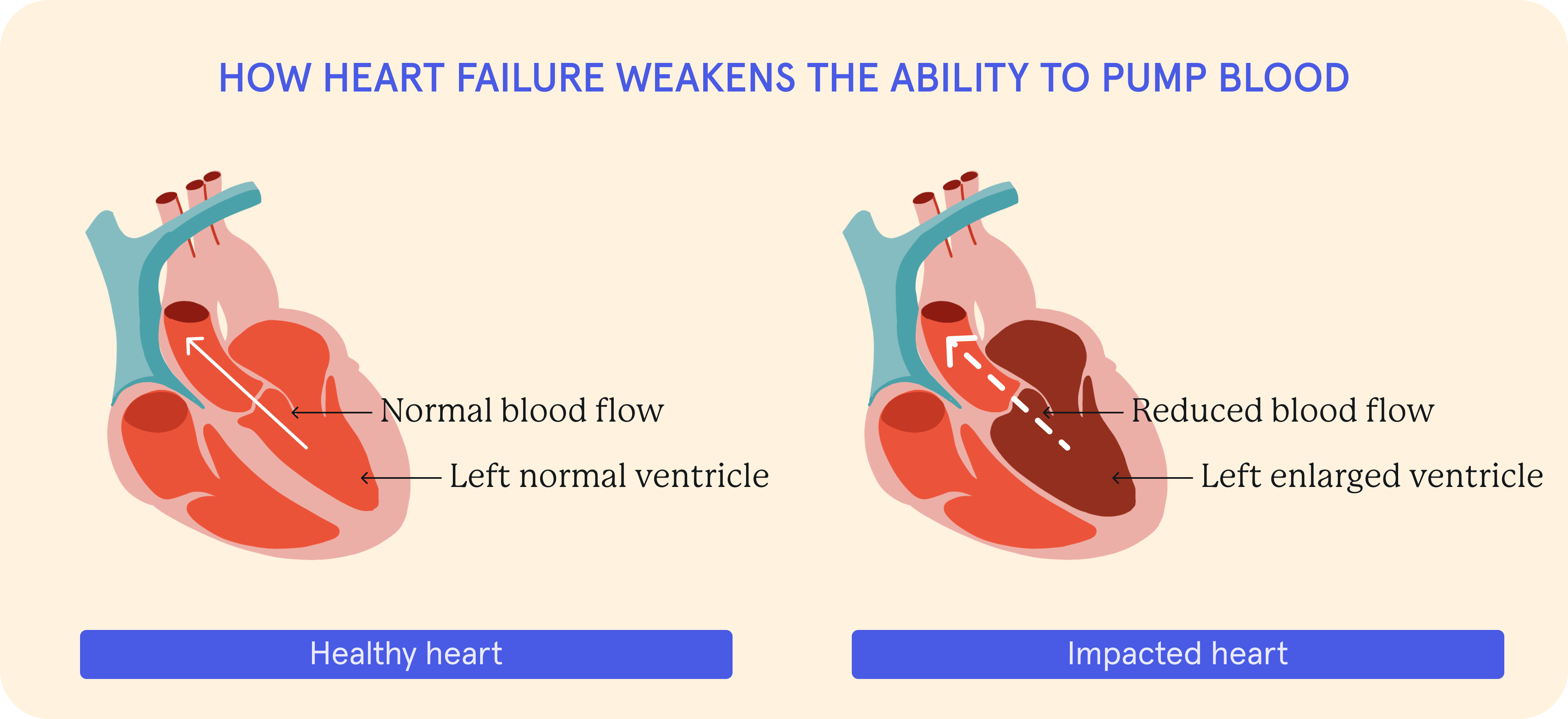 How heart failure weakens the ability to pump blood