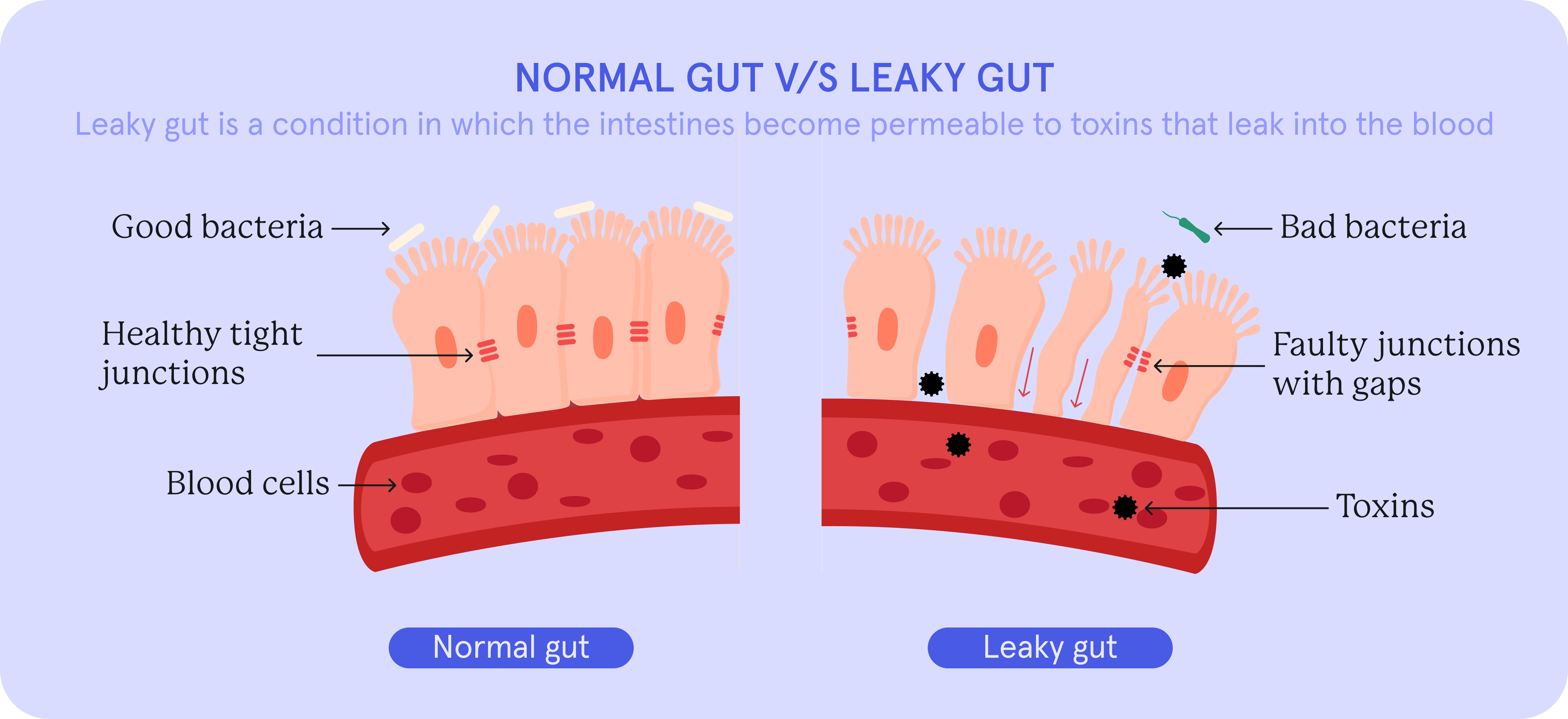 an infographic with illustrations showing the difference between a normal gut and a leaky gut