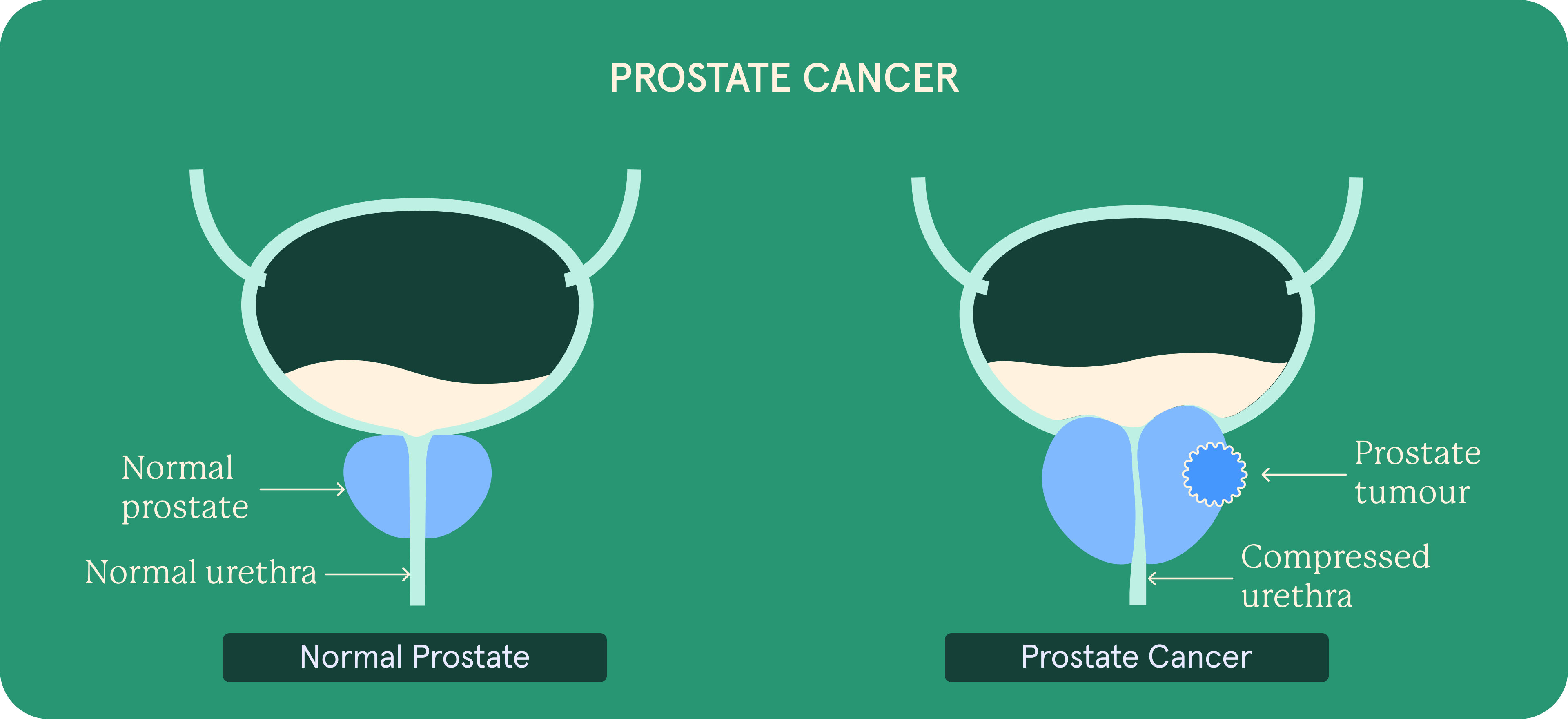 Prostate cancer