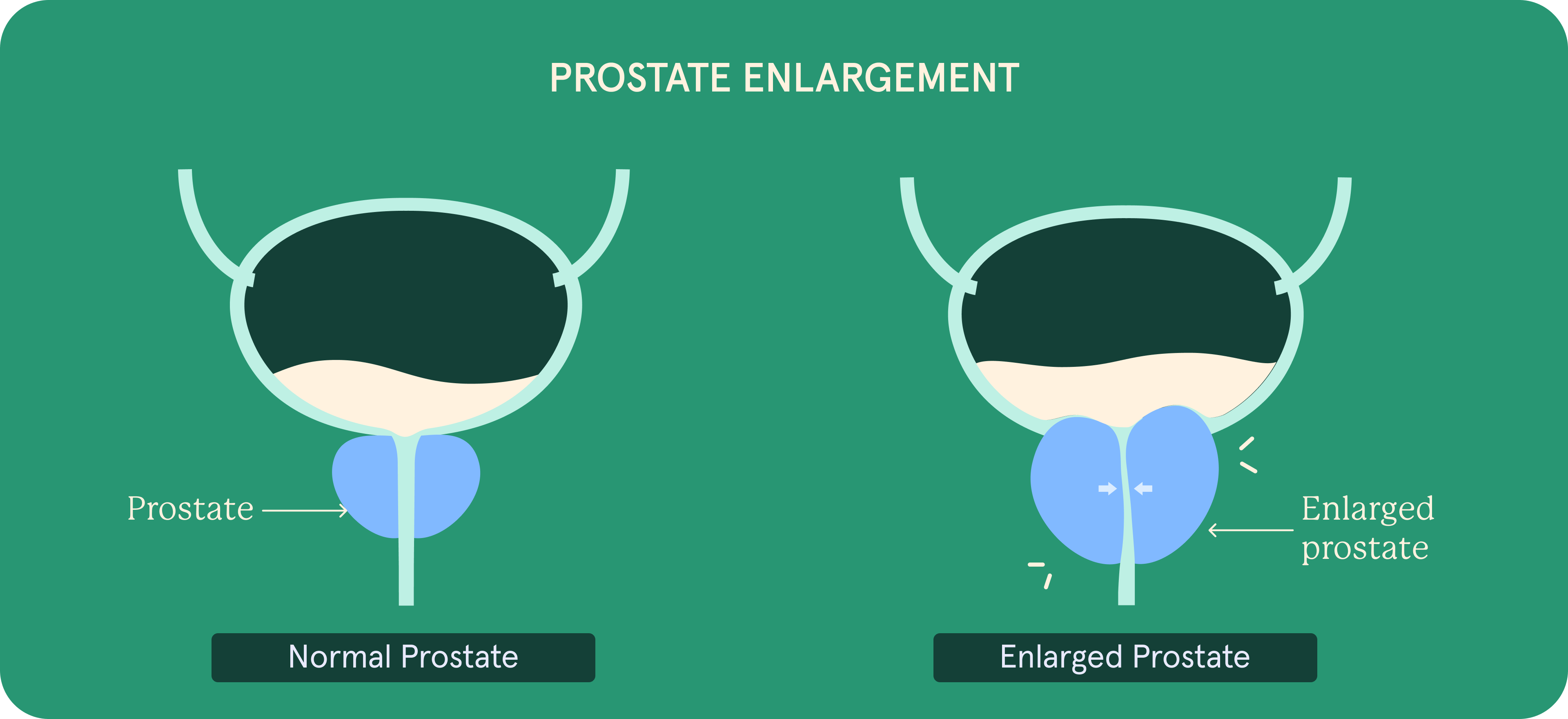 Prostate enlargement