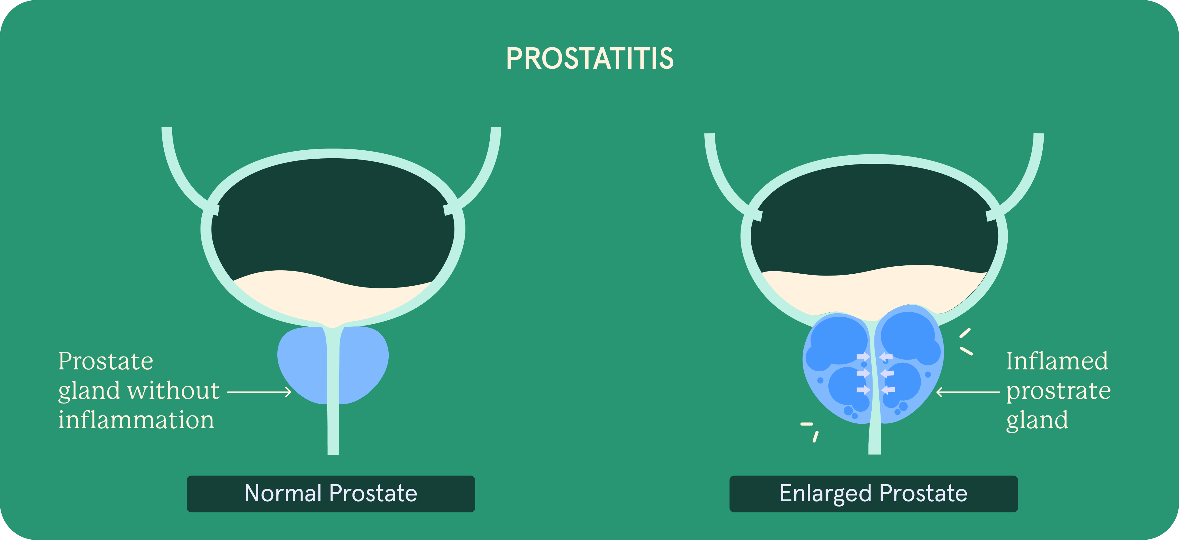 Prostatitis