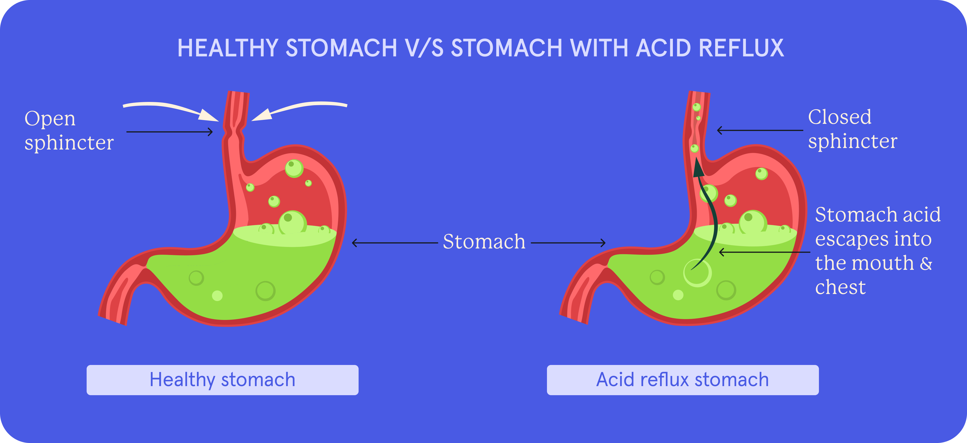 An infographic on healthy stomach vs. stomach with acid reflux.