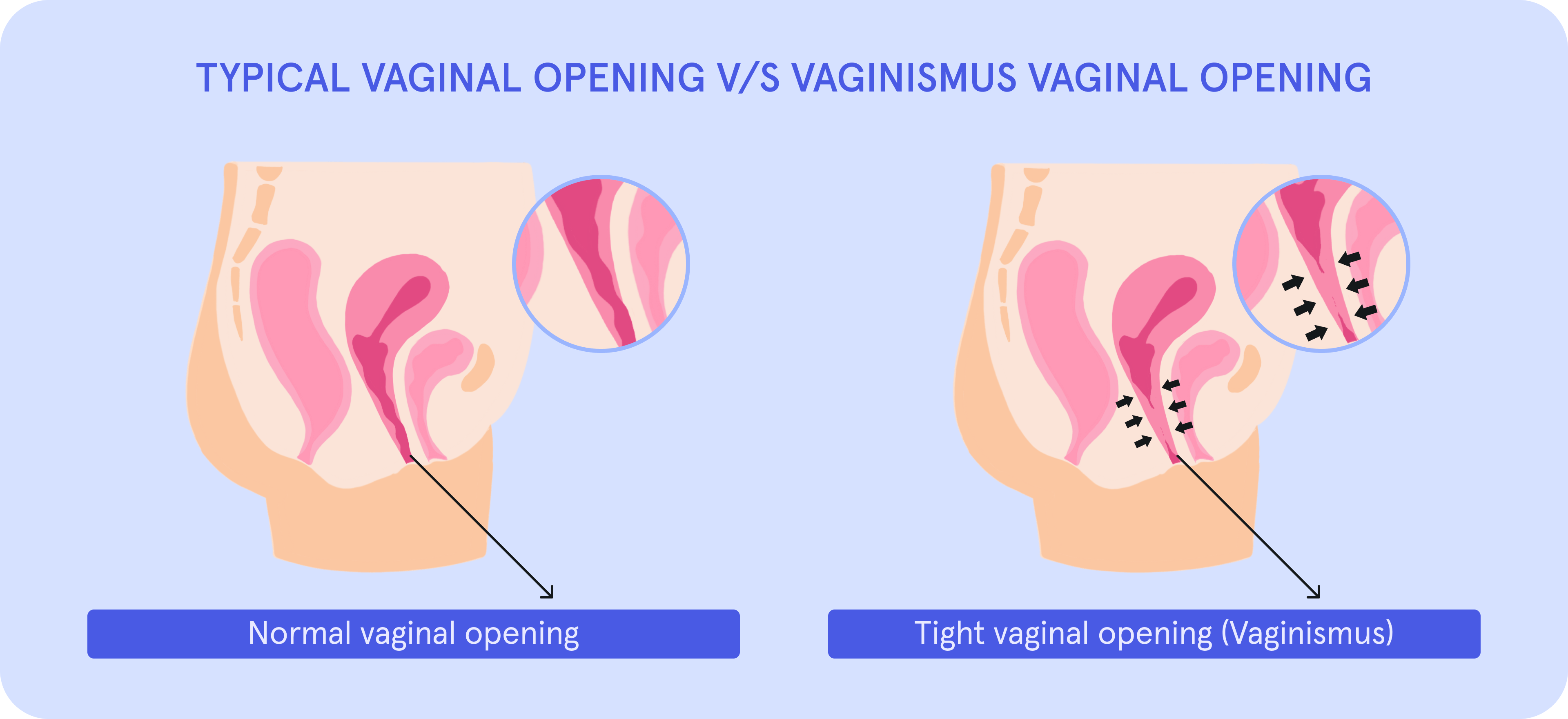 An infographic on Typical vaginal opening VS Vaginismus vaginal opening.