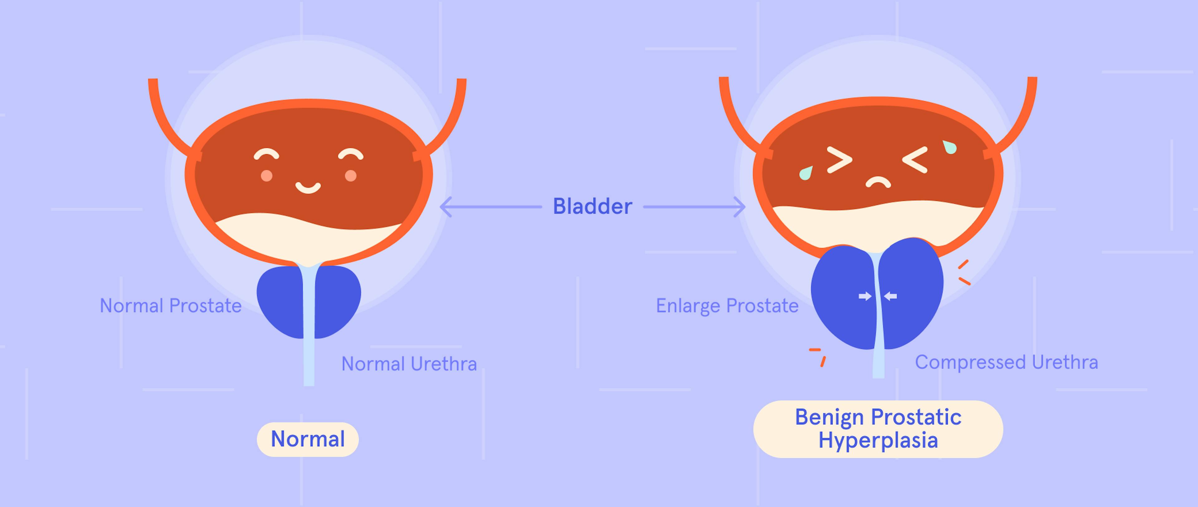 Is It Just a Peeing Problem or a Prostate Issue? Let’s Demystify BPH.