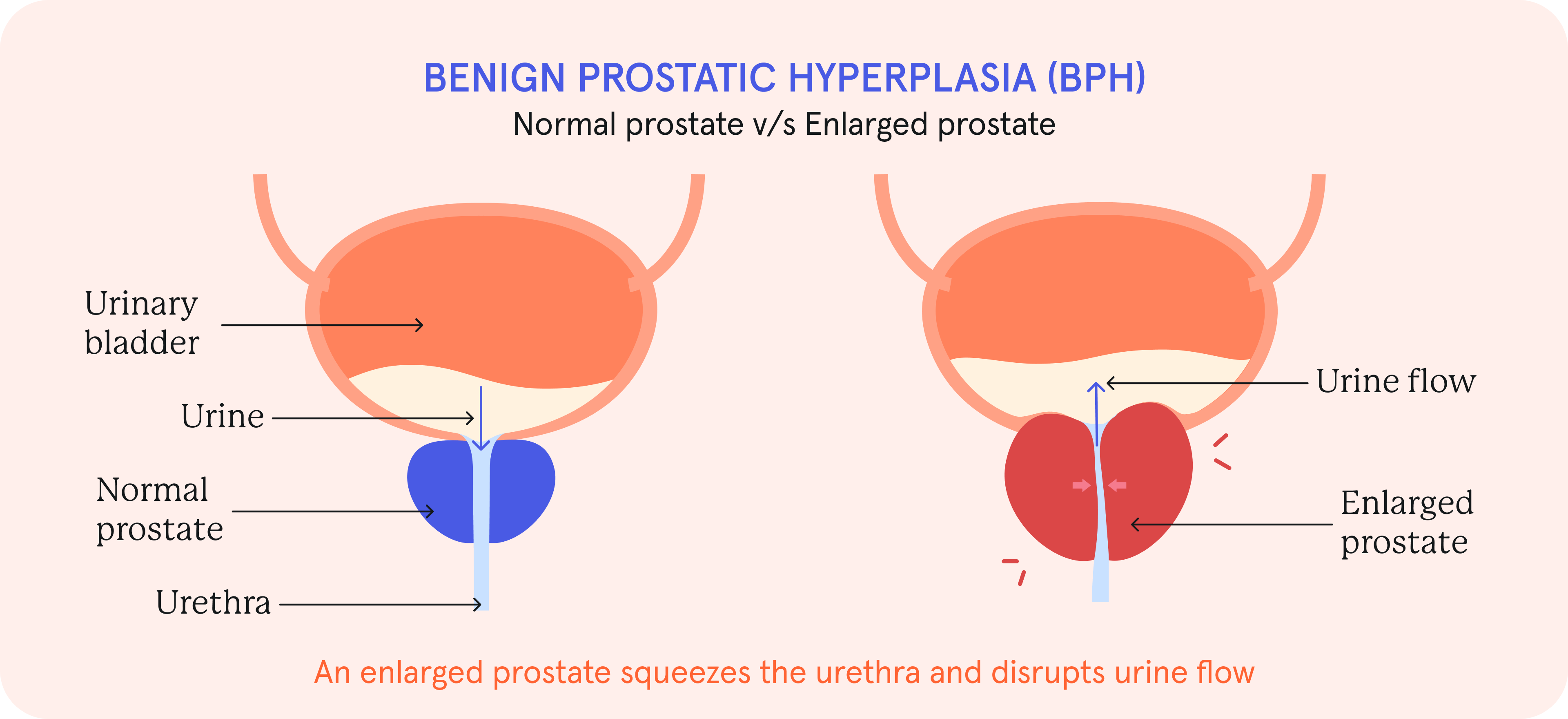 An infographic of Benign prostatic hyperplasia (BPH).