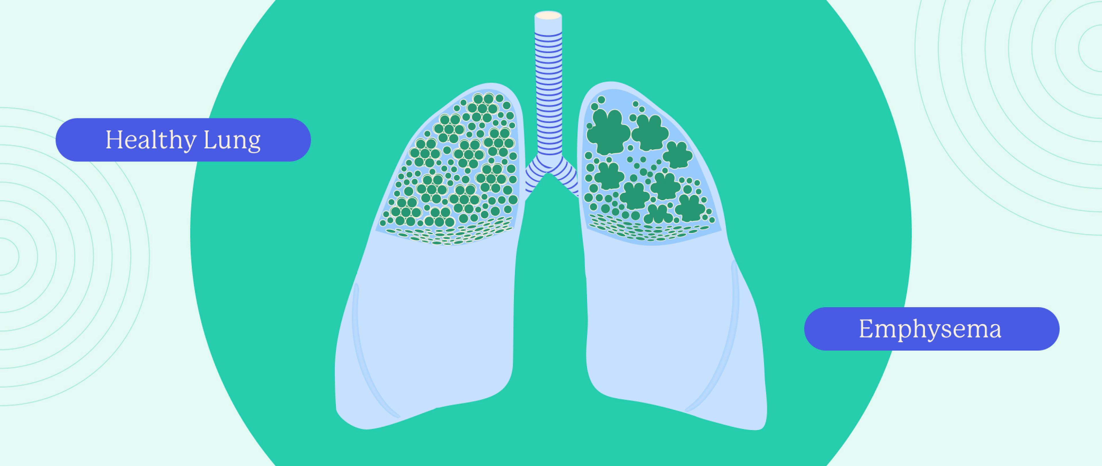 A pictorial representation of healthy and infected lungs.