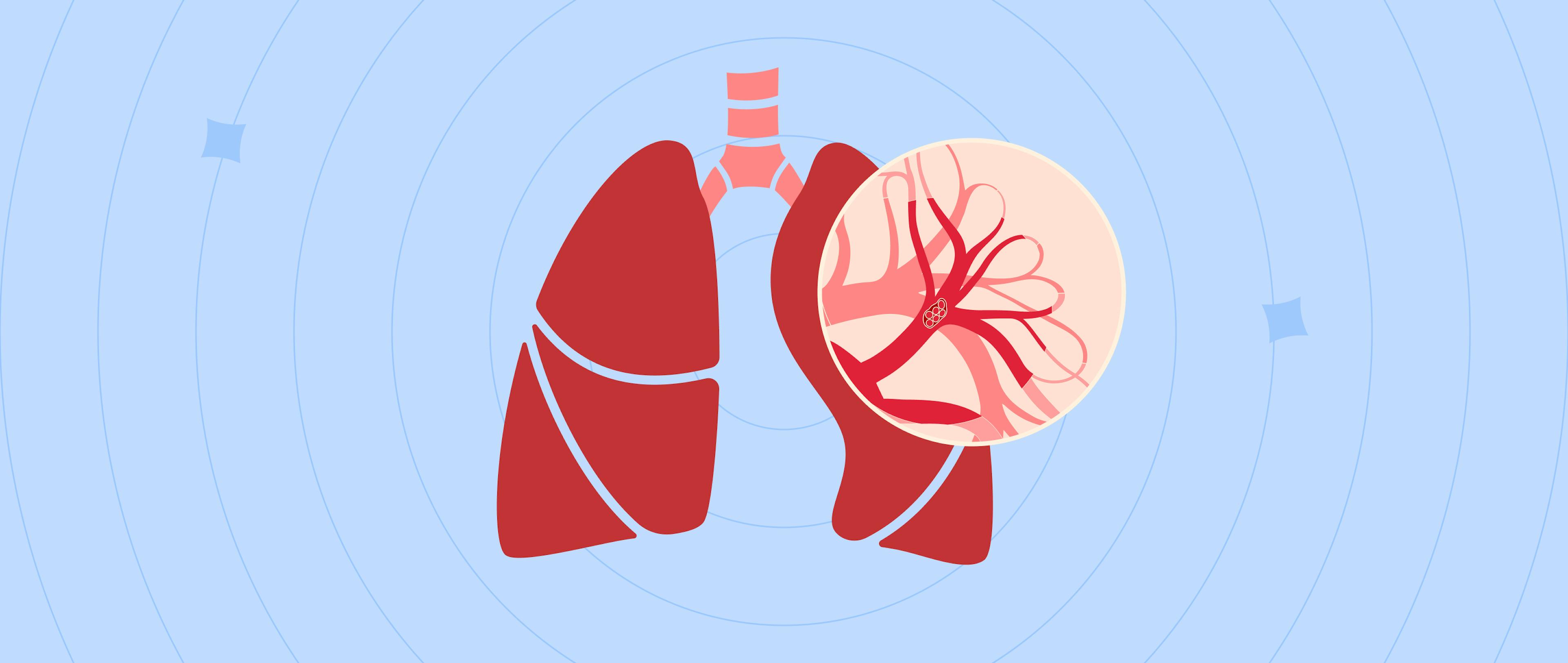 Blood clot in lung vein close-up anatomical poster. Blocking blood flow in lungs.