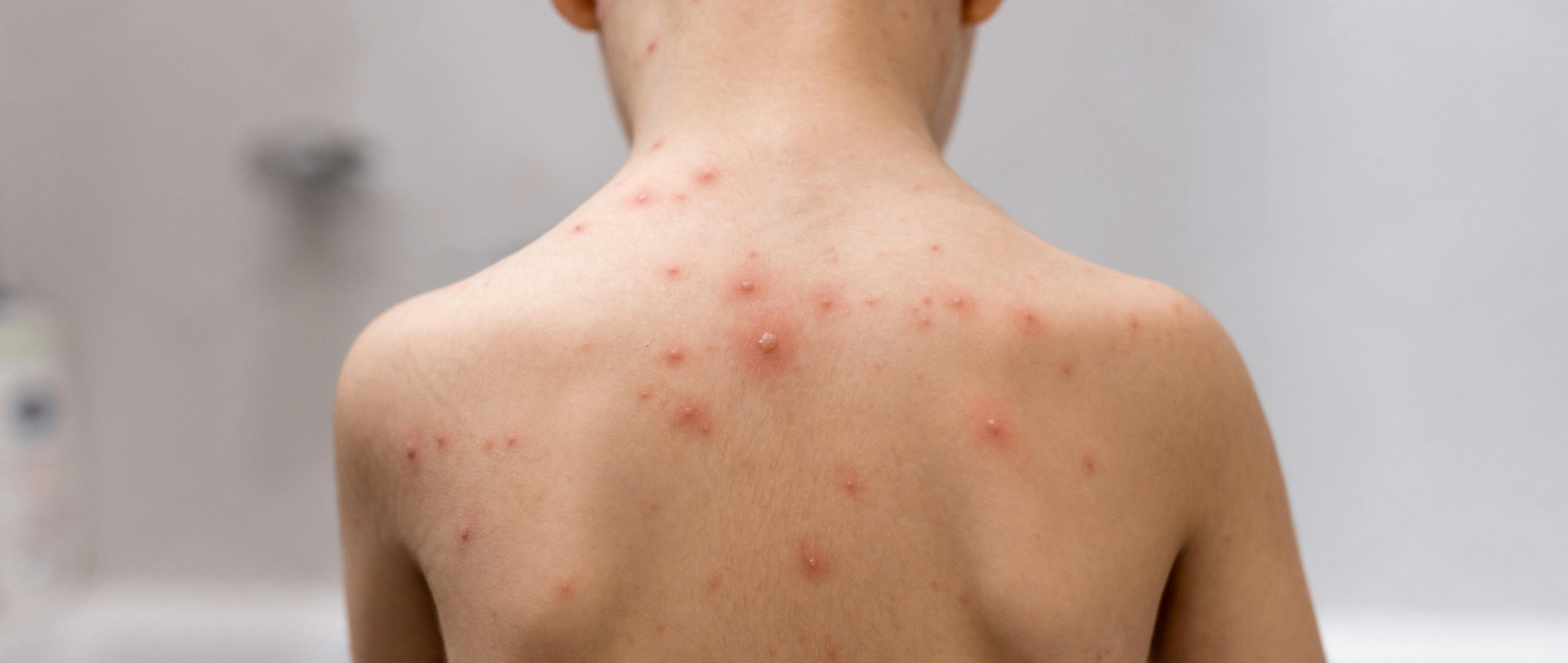 Boy with chickenpox.