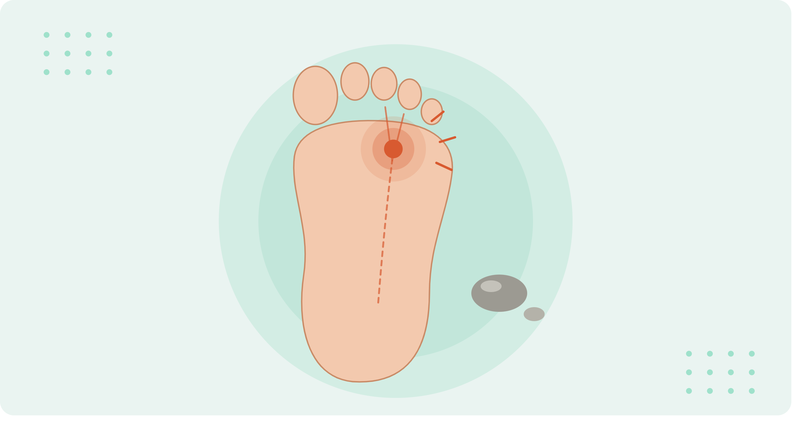 Morton’s neuroma pain between the third and fourth toes, illustrated on a foot.