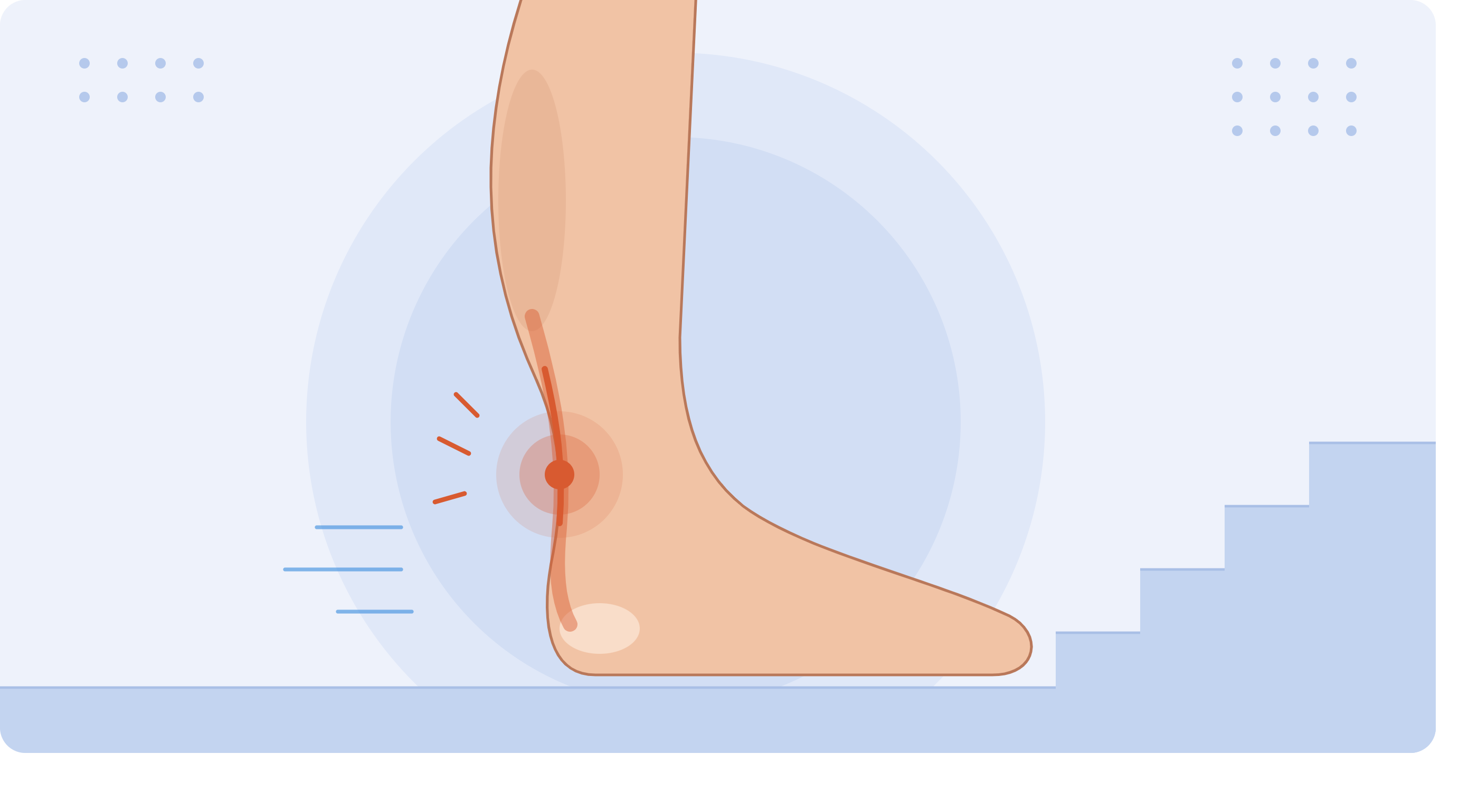 Illustration of a lower leg showing Achilles tendon pain above the heel, with stairs in the background.