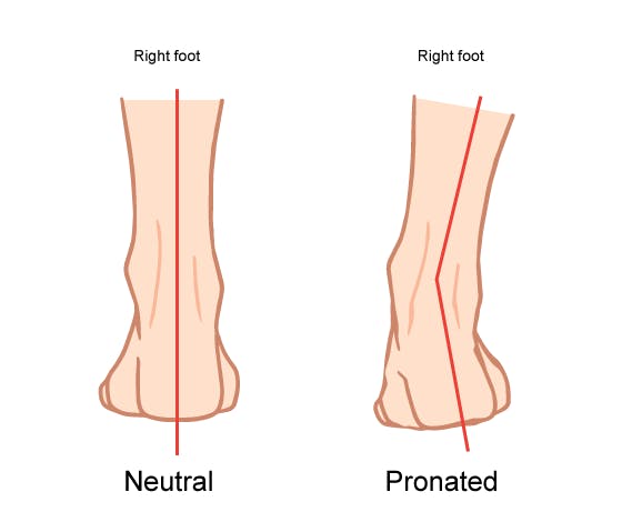 Orthotics for Overpronation